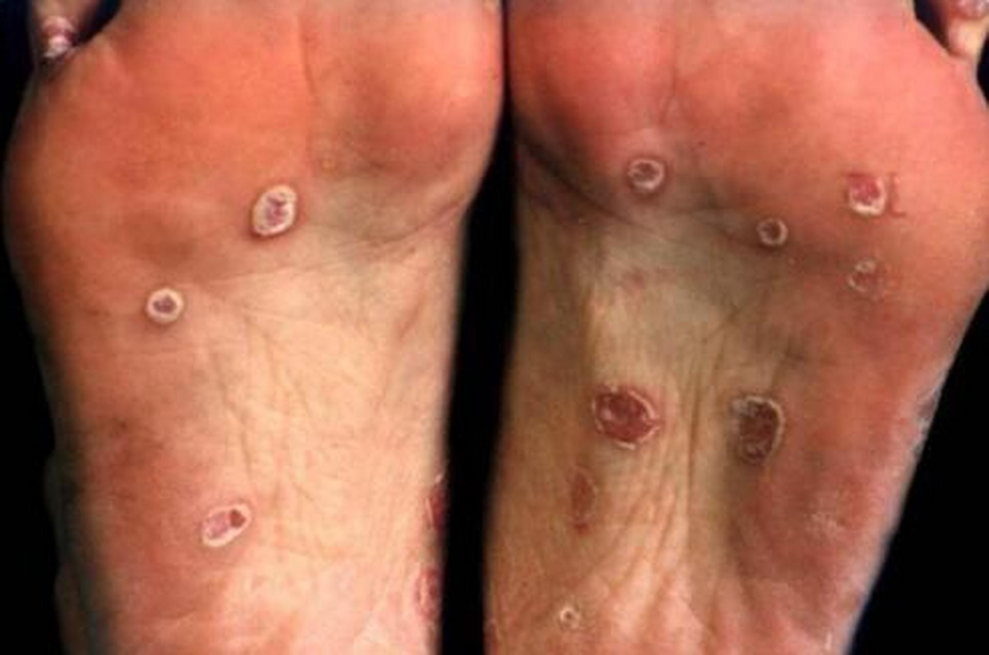 假如近期有过无保护高危性接触,那么这很可能是二期梅毒疹,可能感染