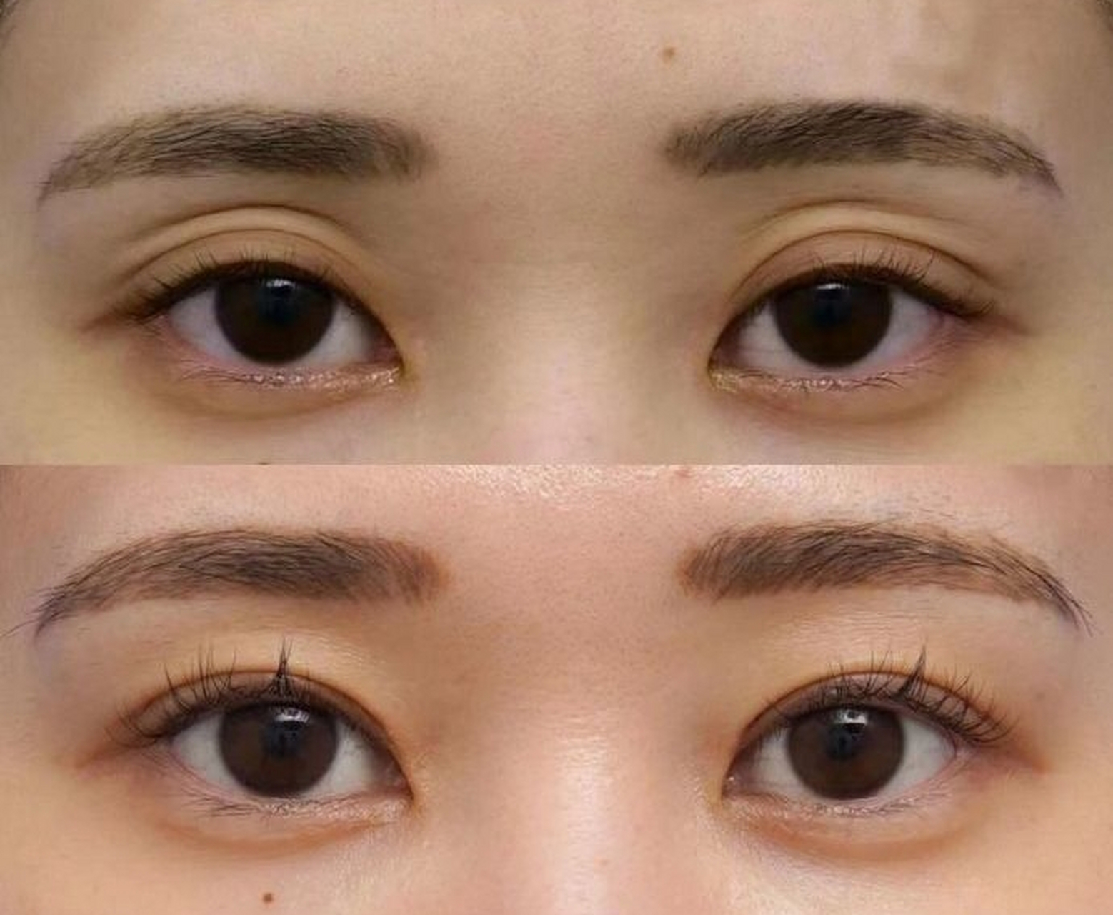 随着年龄的增长,眼眶骨变薄,脂肪逐渐流失,很容易出现眼窝凹陷的问题