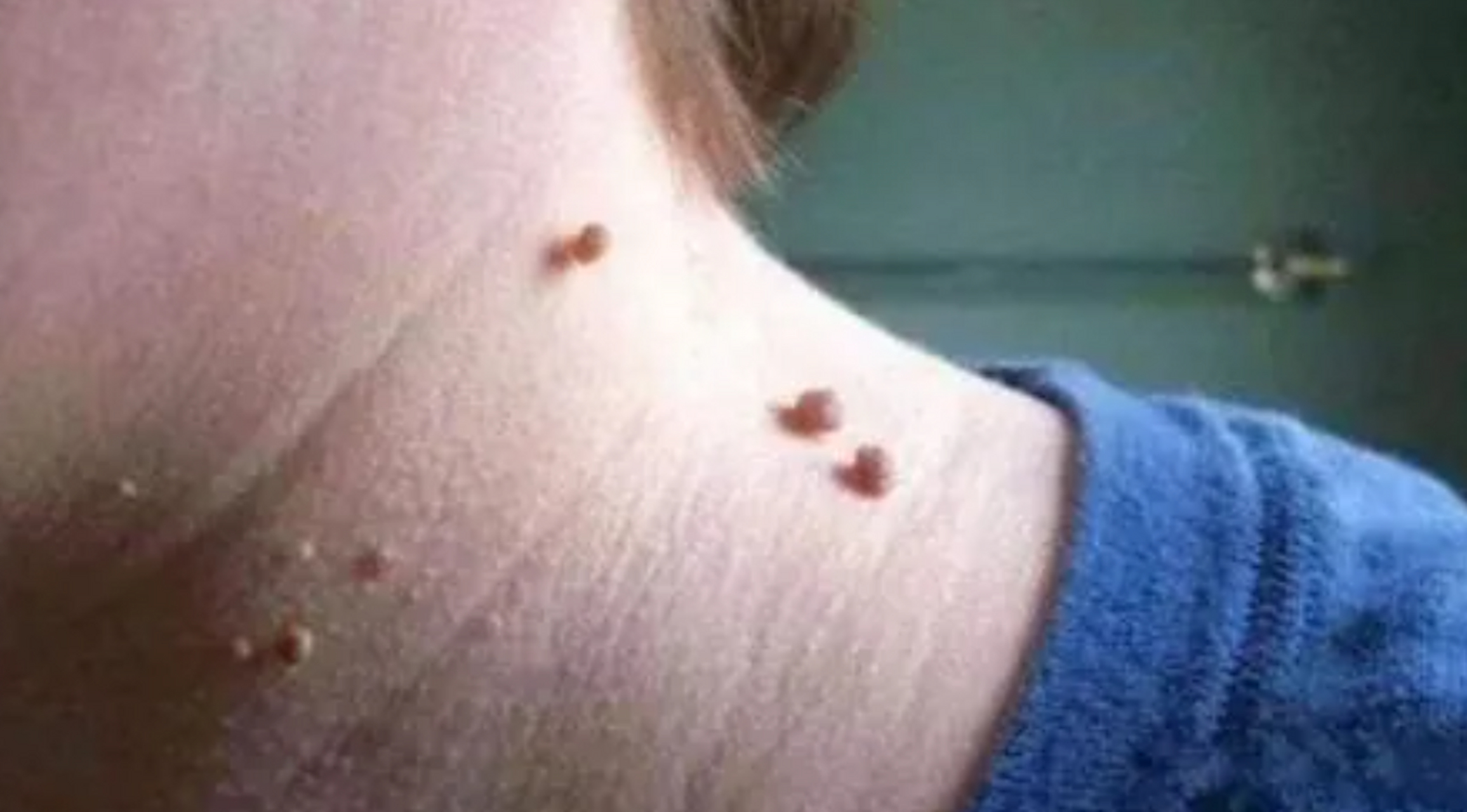 脖子上长这种病毒疣,千万别扣!别剪!