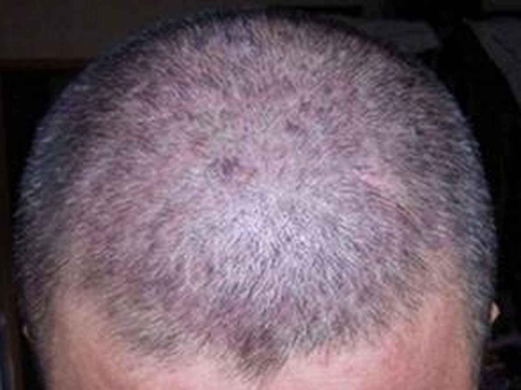 正确选择适合头皮银屑病患者的洗发水是缓解症状,改善头皮健康的重要