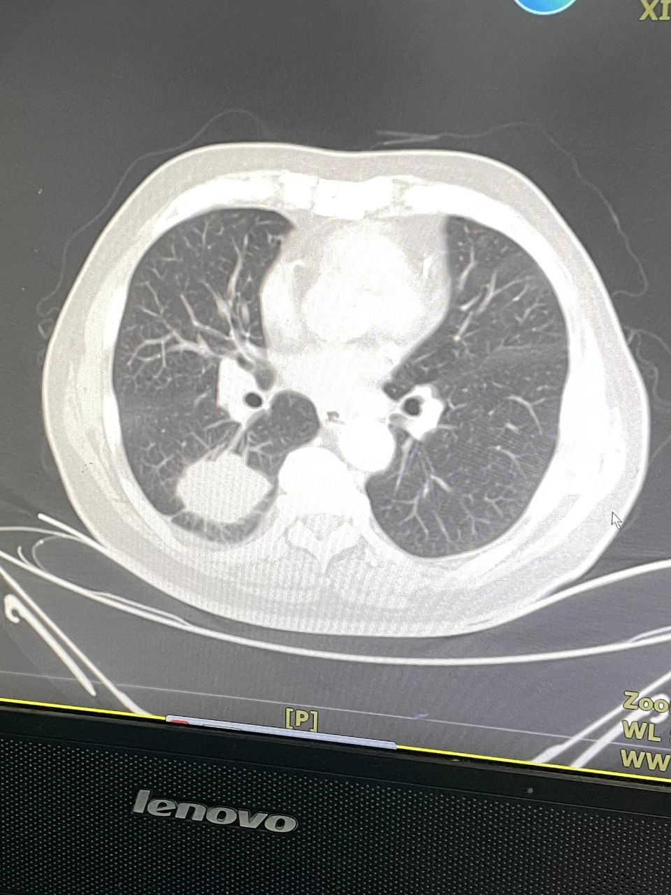 从医30年的肿瘤科主任告诉你,肺鳞癌的正确治疗方法 肺鳞癌是一种常见
