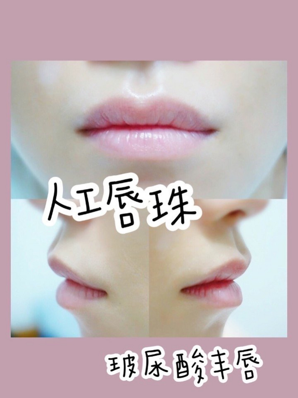 打唇珠打嘟嘟唇!还流行么?还好看么?