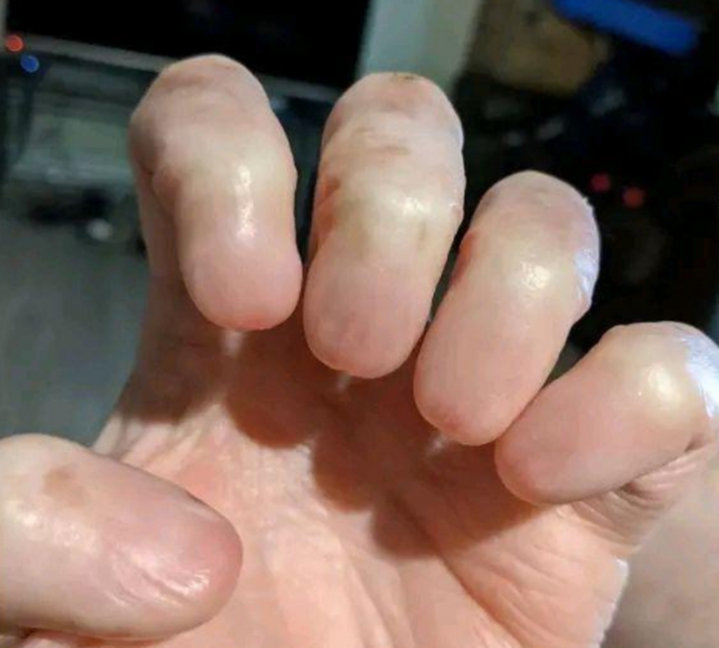 你们见过这种天生不长指甲的吗