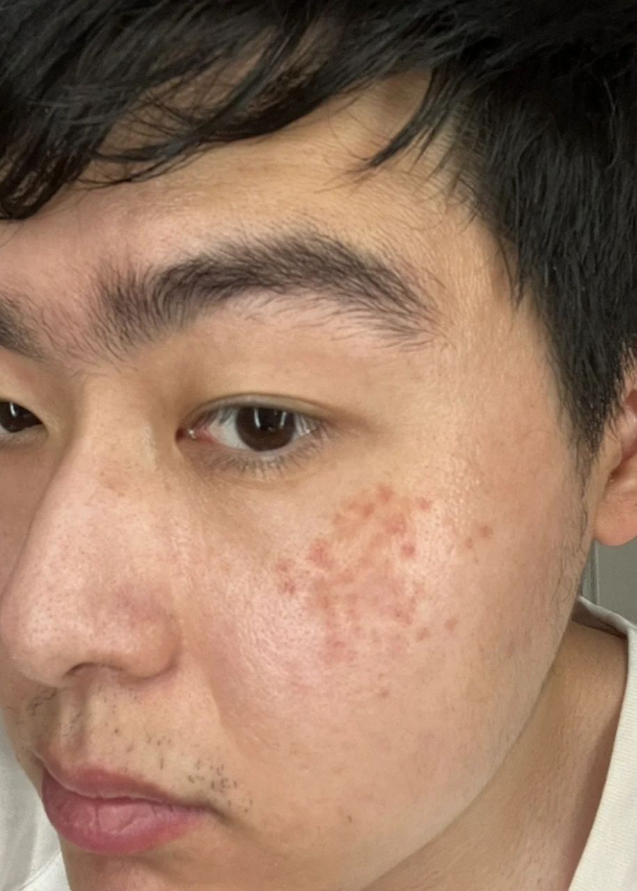 点斑后色素回流满脸黑印怎么淡化 #医美科普挑战赛#  点斑后色素回流