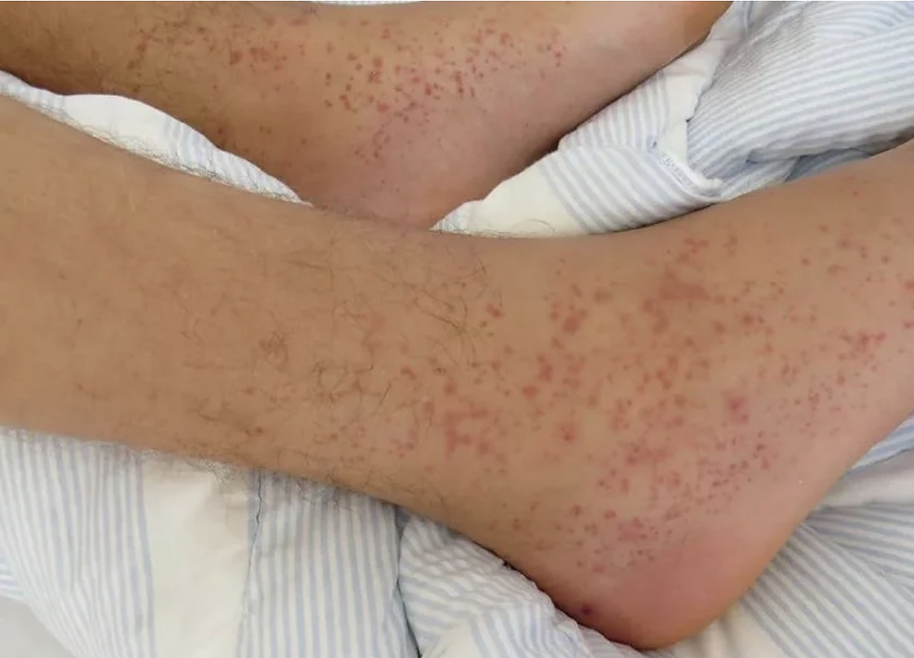 1过敏性紫癜一直反复发作的患者,可以通过中医方法进行治疗,除了服用