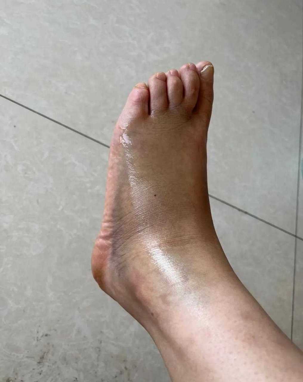 下楼梯摔了,脚崴这样,肿的就像粽子似的,好多瘀血