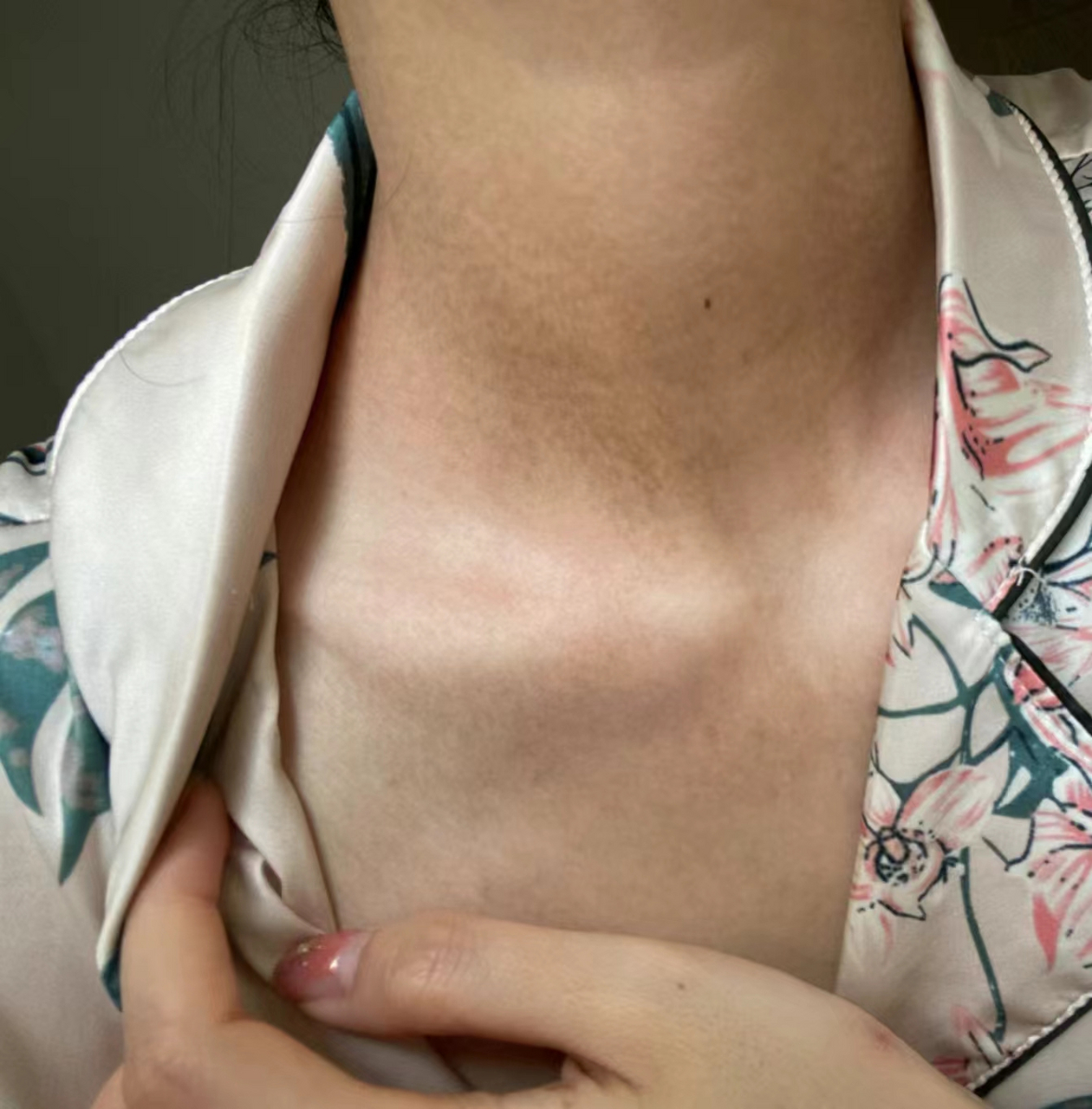 脖子上有咖啡斑怎么办?