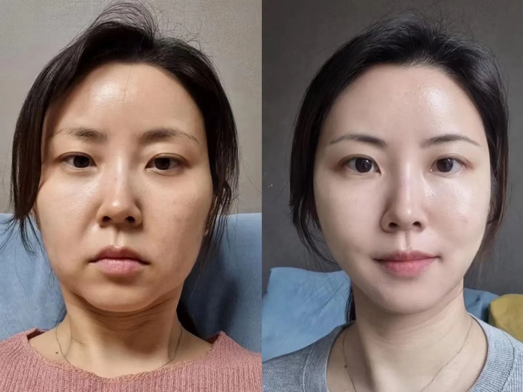 不要学别人做"苹果肌复位","破相",疼,影响生活,这些还不是要自己承担