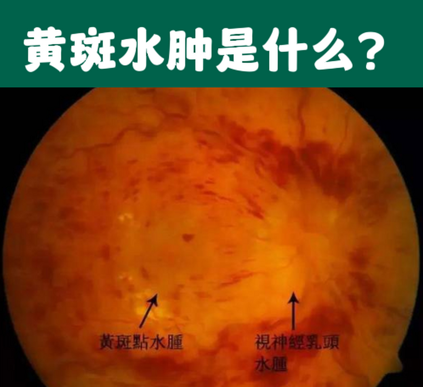 黄斑水肿是什么?