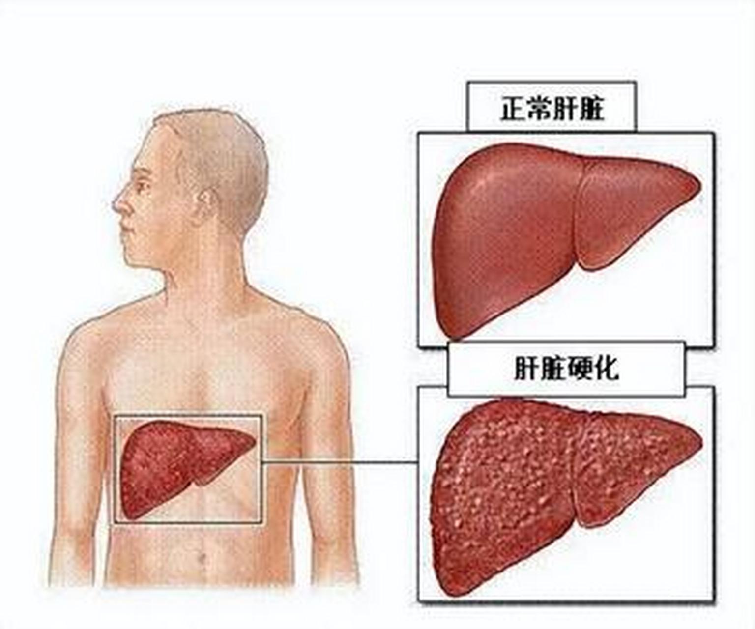 肝硬化失代偿期打不破5年的魔咒吗 由于肝硬化患者肝脏的纤维化很难