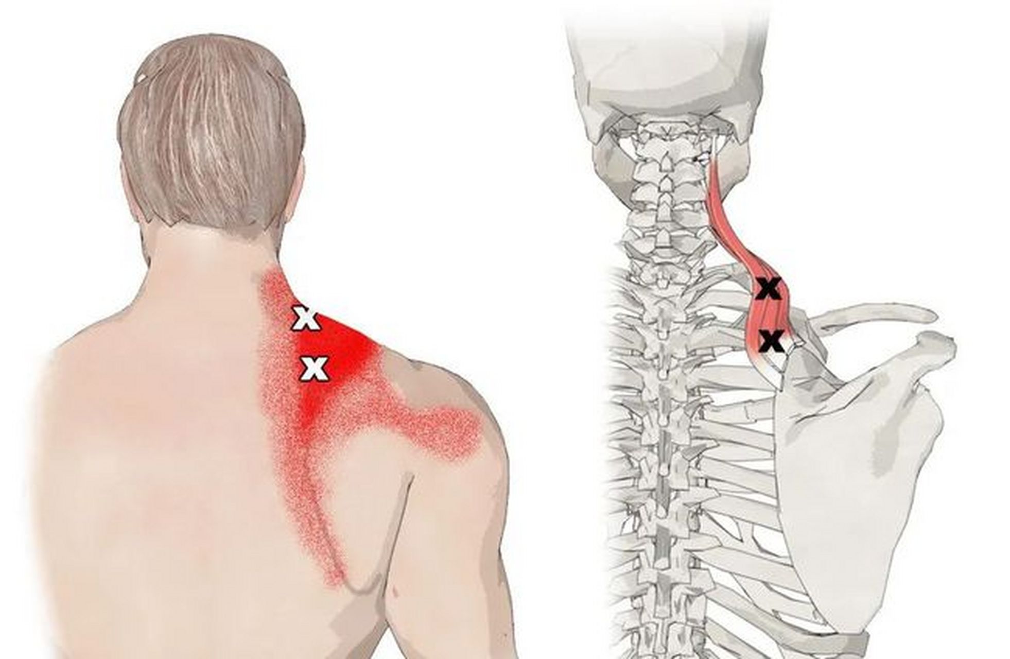 两个常见原因  [大哭] 1,能找到痛点——肌肉受损 如果你觉得肩胛骨缝