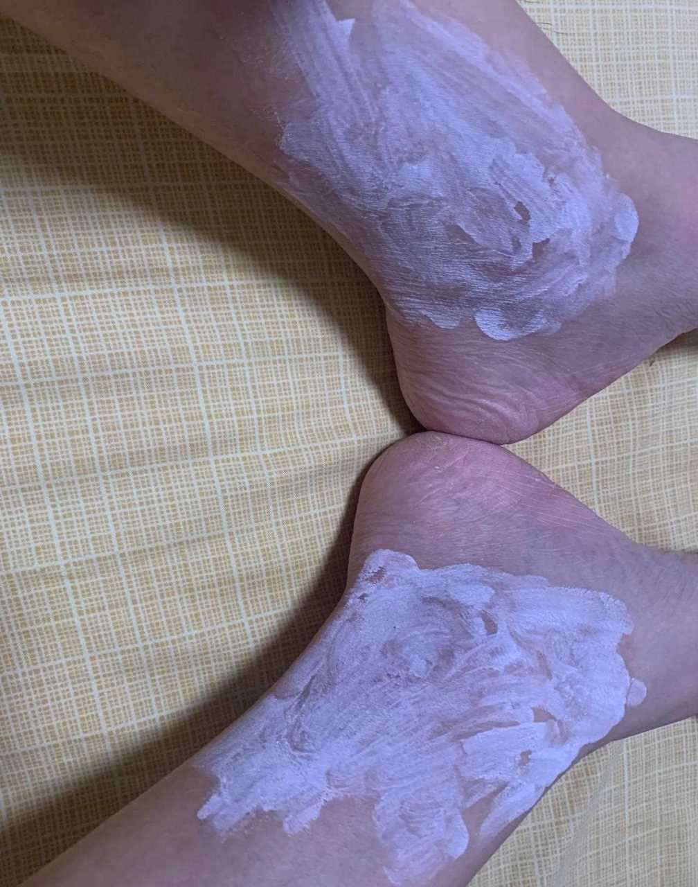 今儿晚上跑步回来,感觉两个脚踝部位痒的厉害,这种状况已经有一段时间