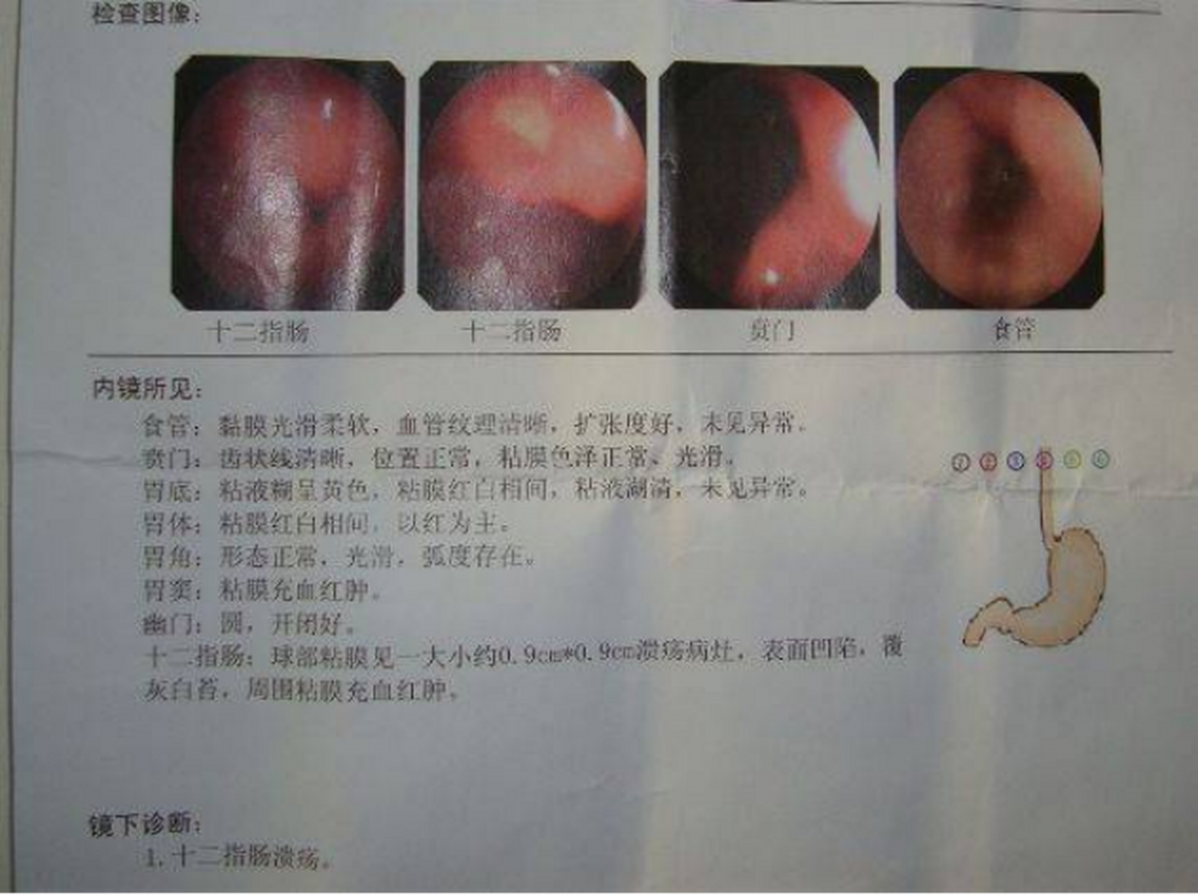 十二指肠炎的症状表现图片