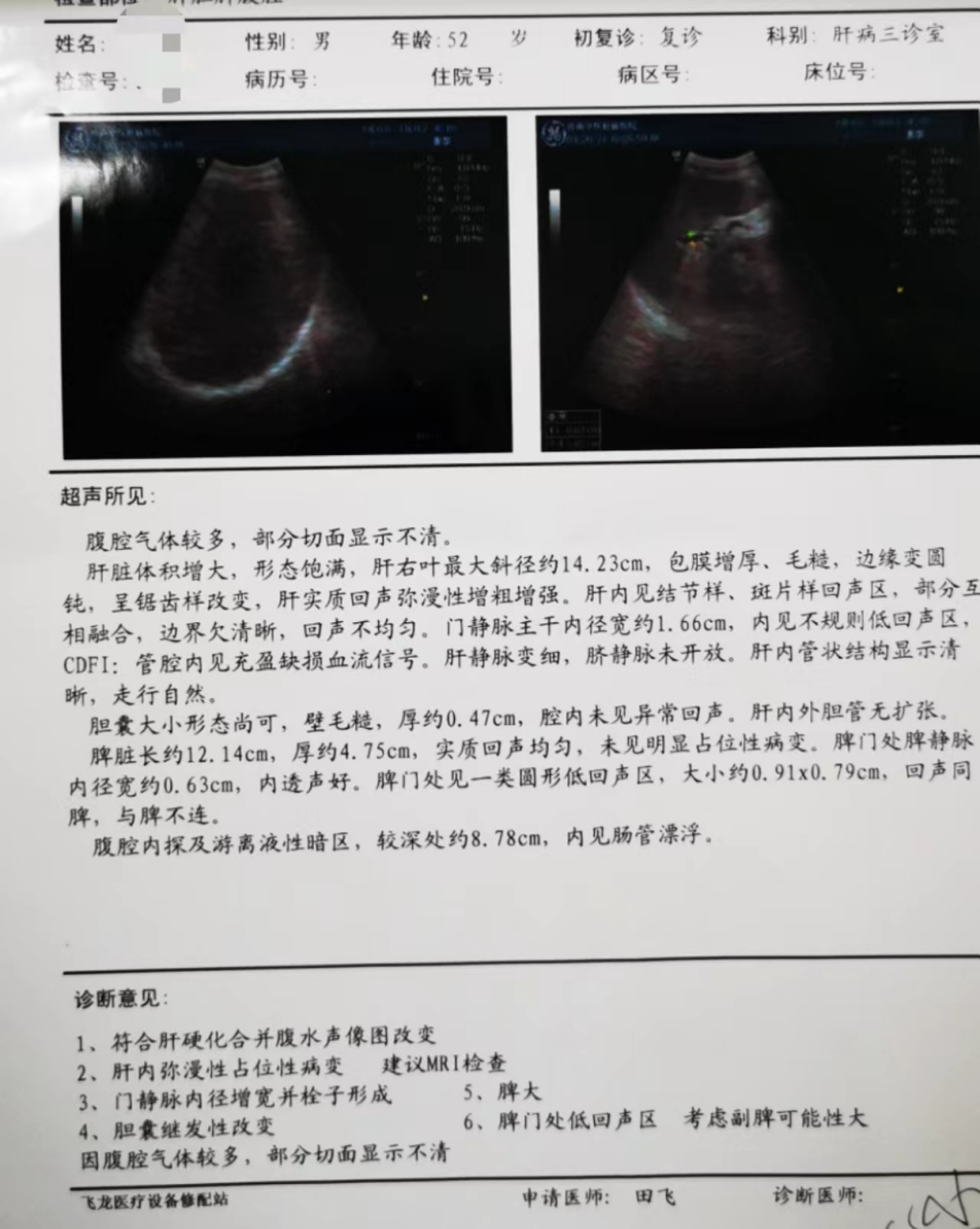 肝硬化超声描述图片