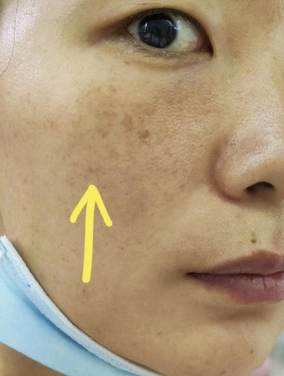 晒斑是由于长时间暴露在阳光下,导致皮肤中的黑色素堆积,形成的一种
