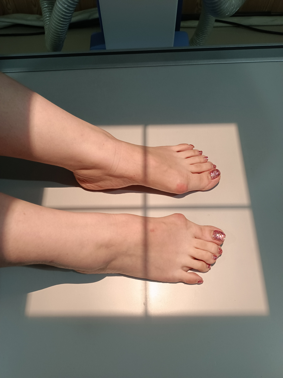 又是忙碌的一天,一大早就来个拇外翻畸形达到43度的,重度拇外翻,年龄