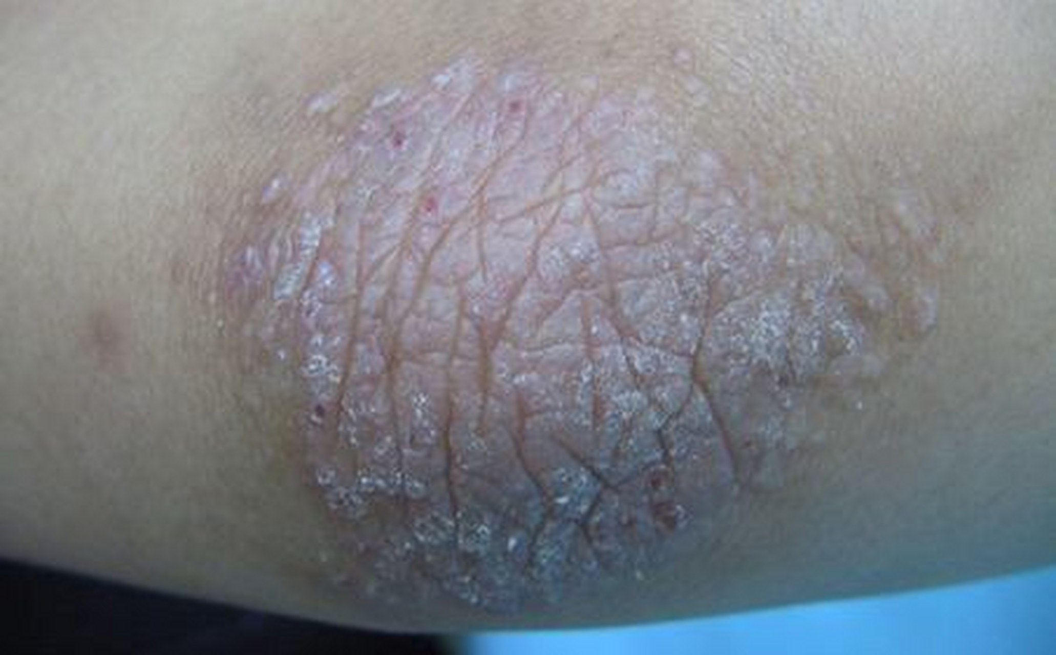 北京大兴的张先生最近发现,自己胳膊上起了几块疙瘩,掉皮还有点痒,他