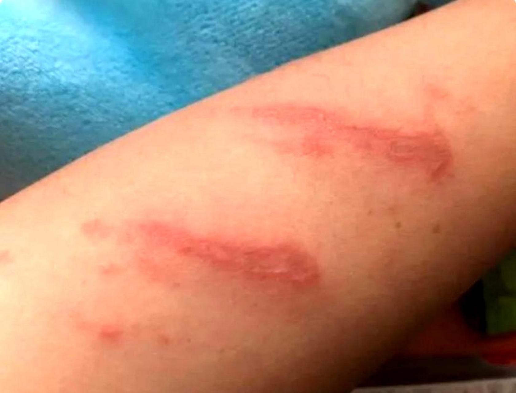 大家要注意隐翅虫,我已经被咬了.