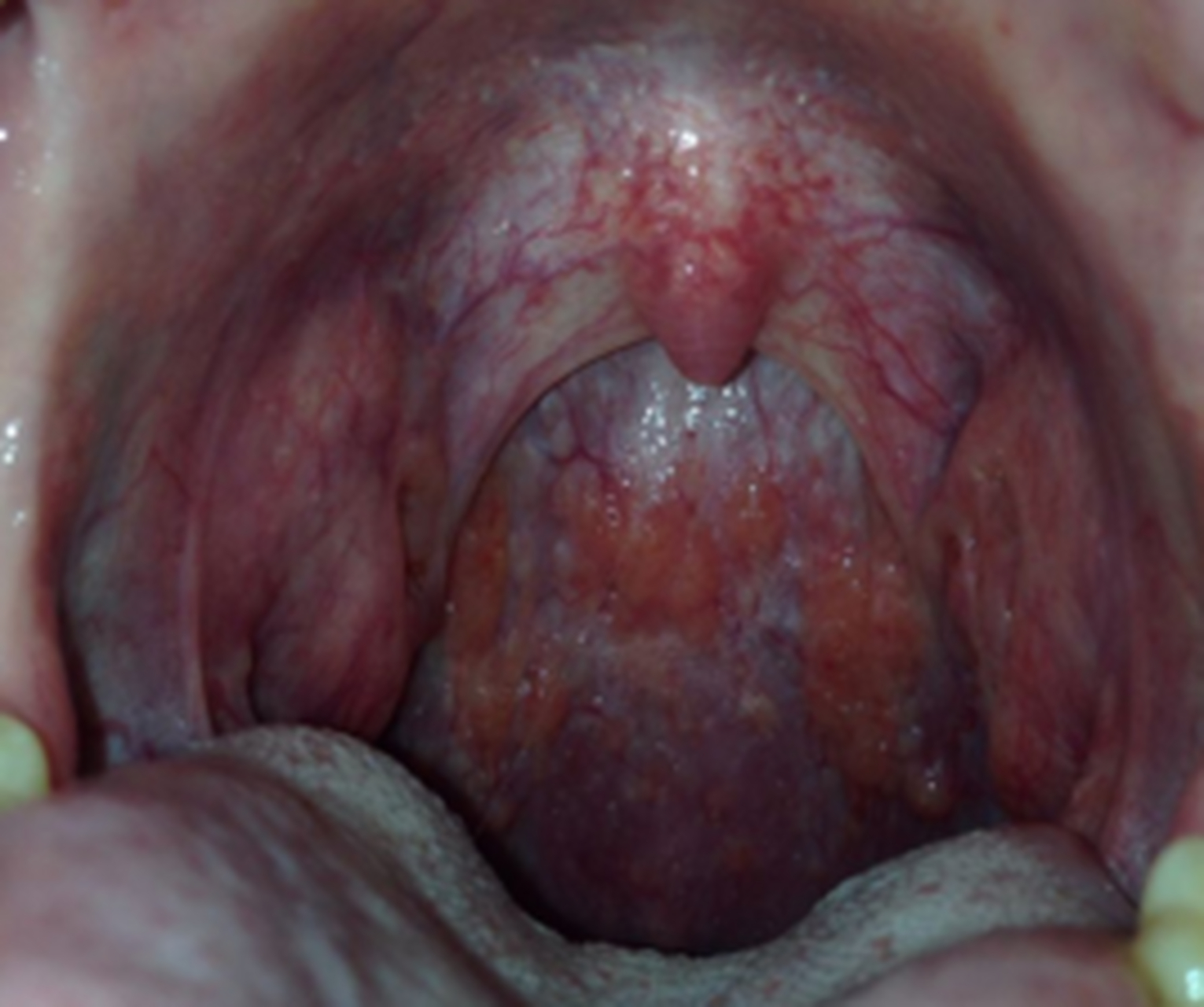 你有没有淋巴滤泡增生,出现喉咙异物感,总感觉嗓子有痰,咳不出咽不下