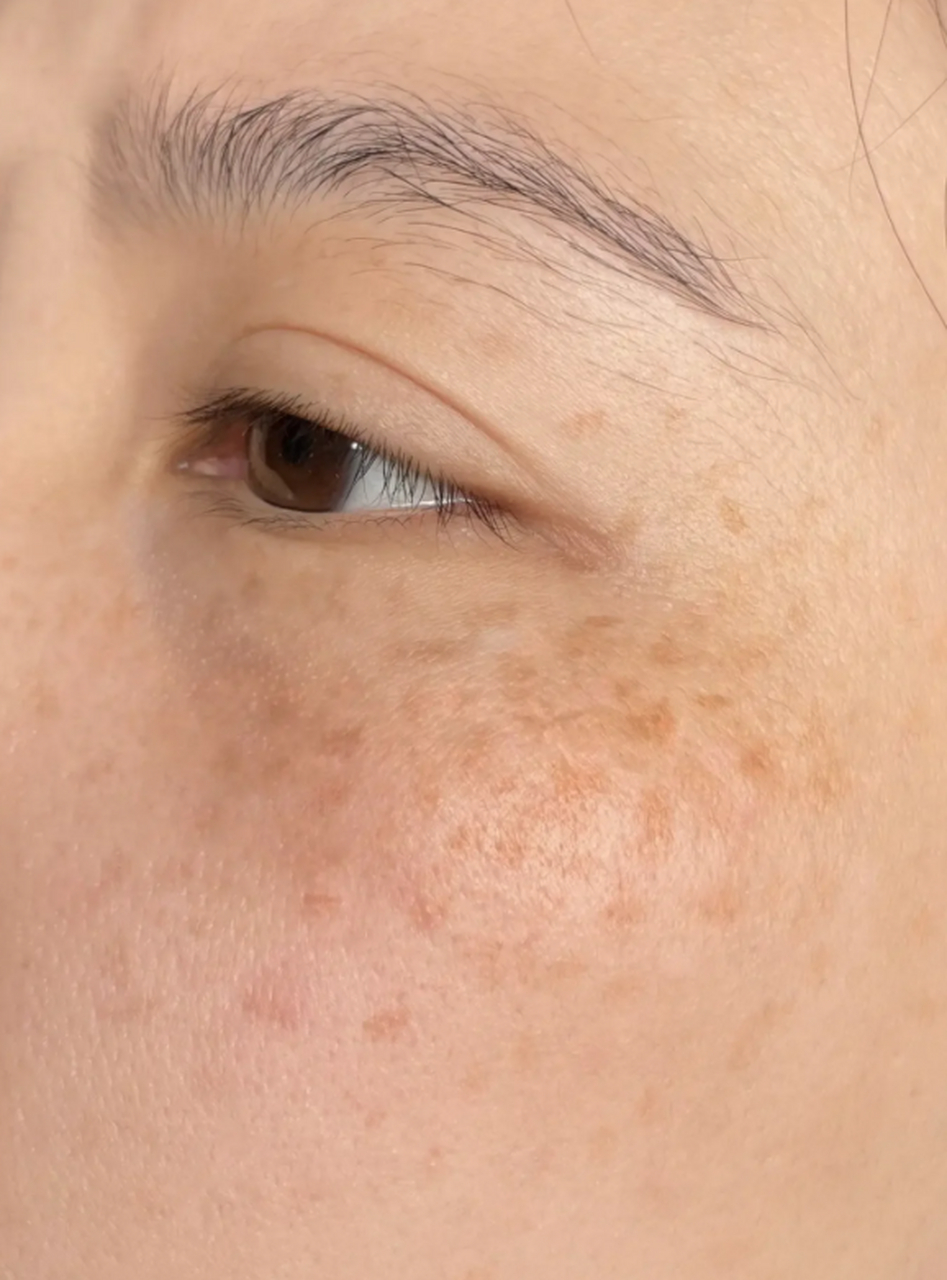 尤其是色斑问题,很多人都会困扰于此.那么,如何有效祛斑嫩肤呢?