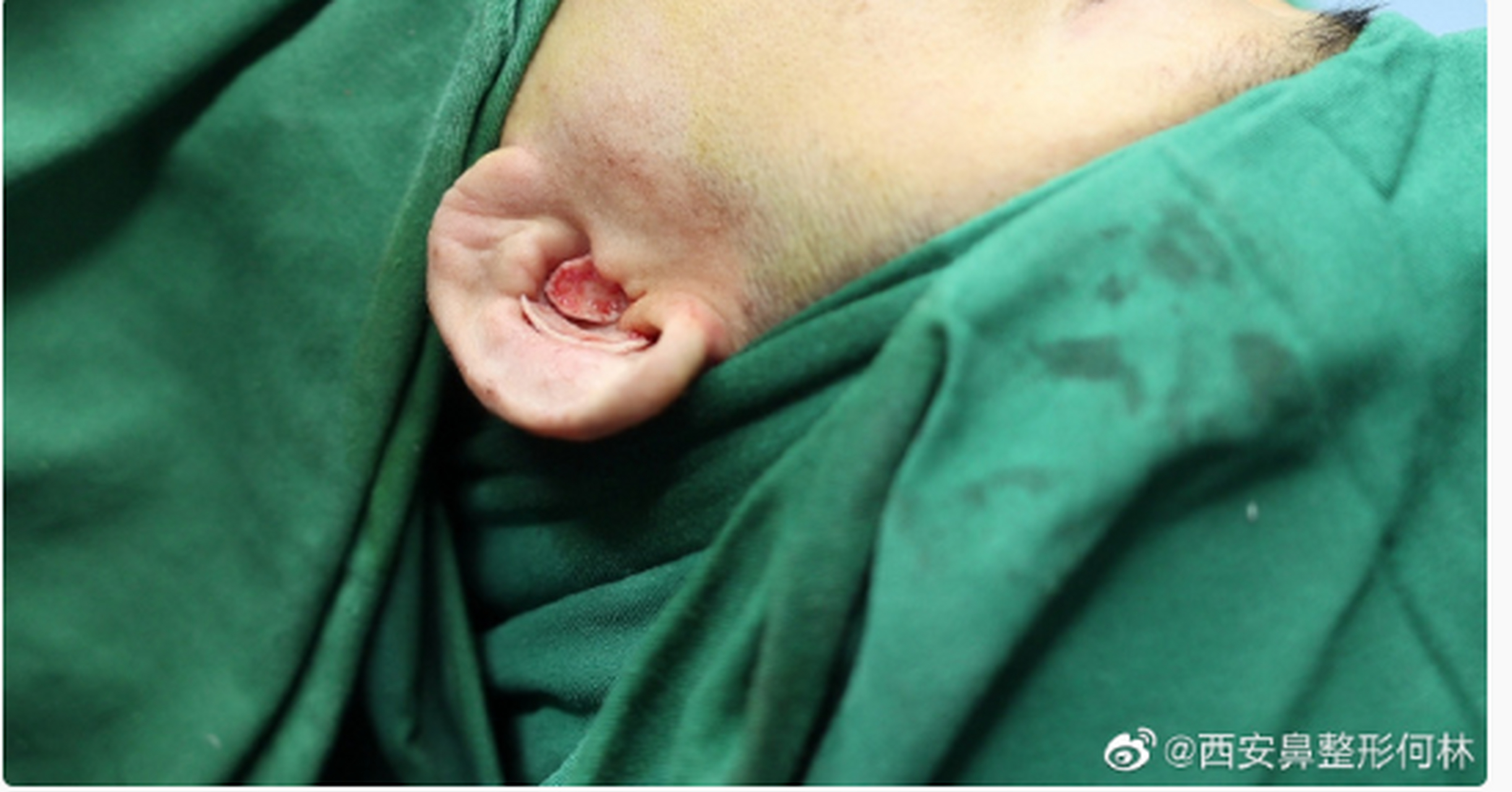 耳朵后面取耳软骨隆鼻,不用担心疤痕 形态问题!
