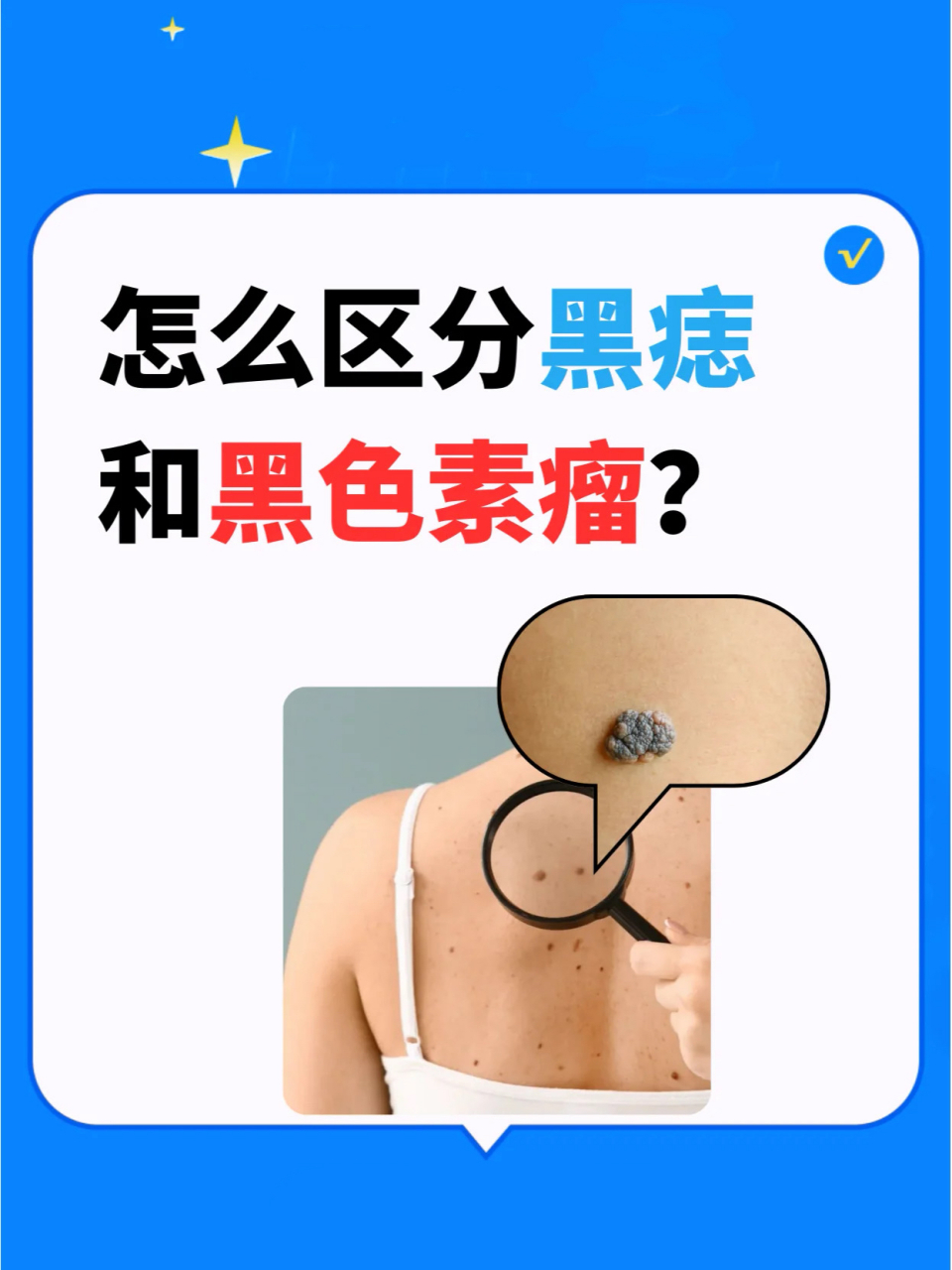 怎么区分黑痣和黑色素瘤