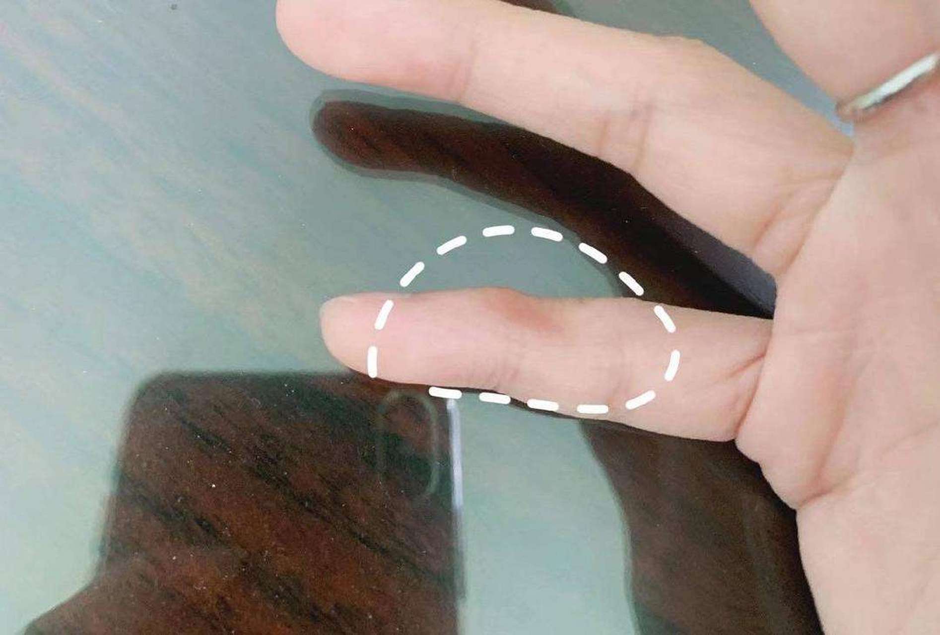 长时间托手机致小拇指变形#虽然现在的手机已经做的很轻薄,但是躺上