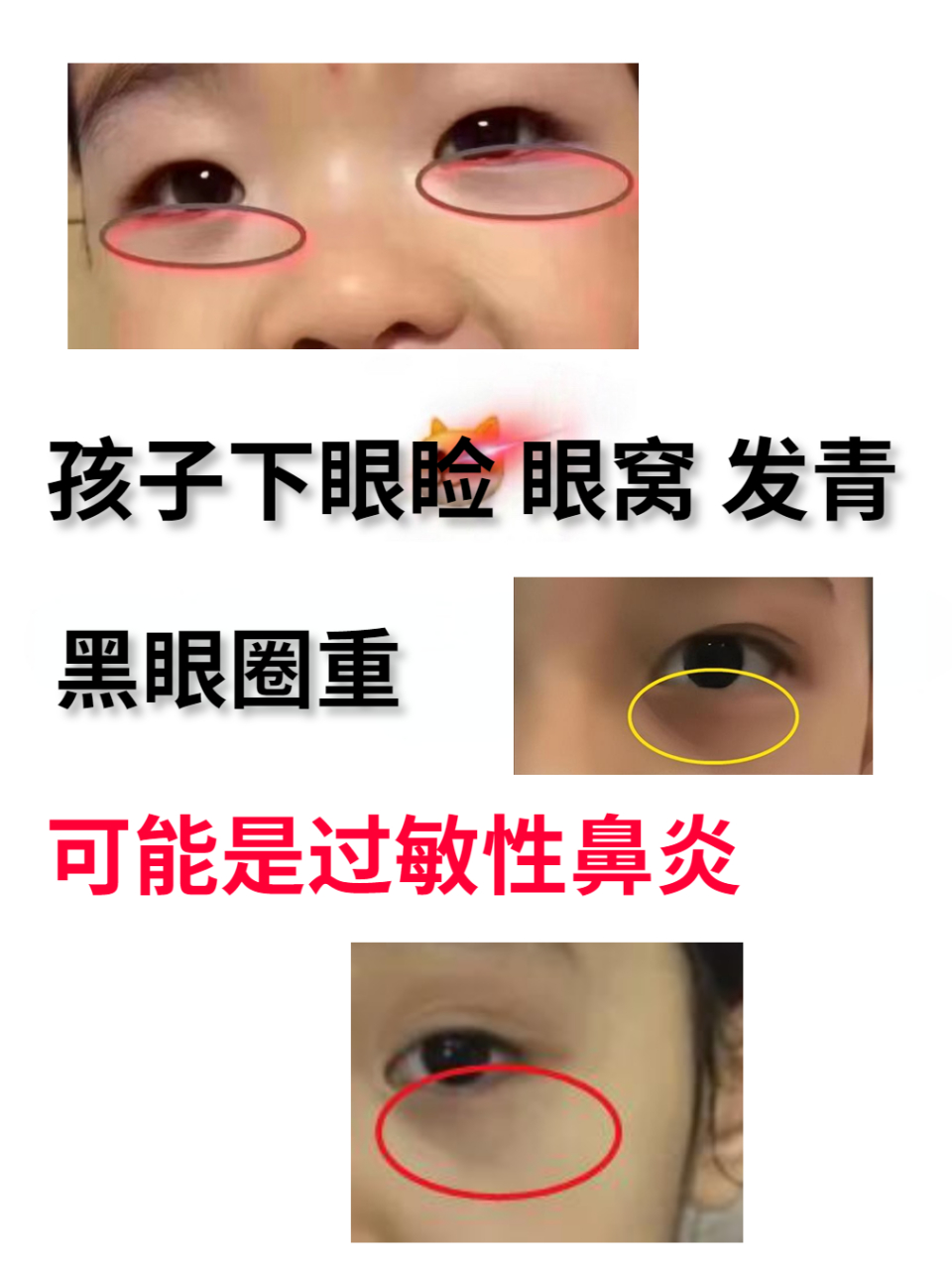 孩子眼窝下眼睑发青,黑眼圈重,可能是鼻炎!