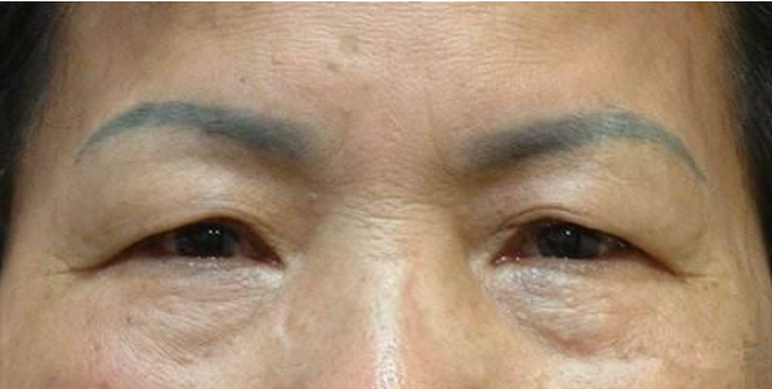 其实,出现眼皮松弛的状况不管是提眉,或者双眼皮都是可以有效地钙善