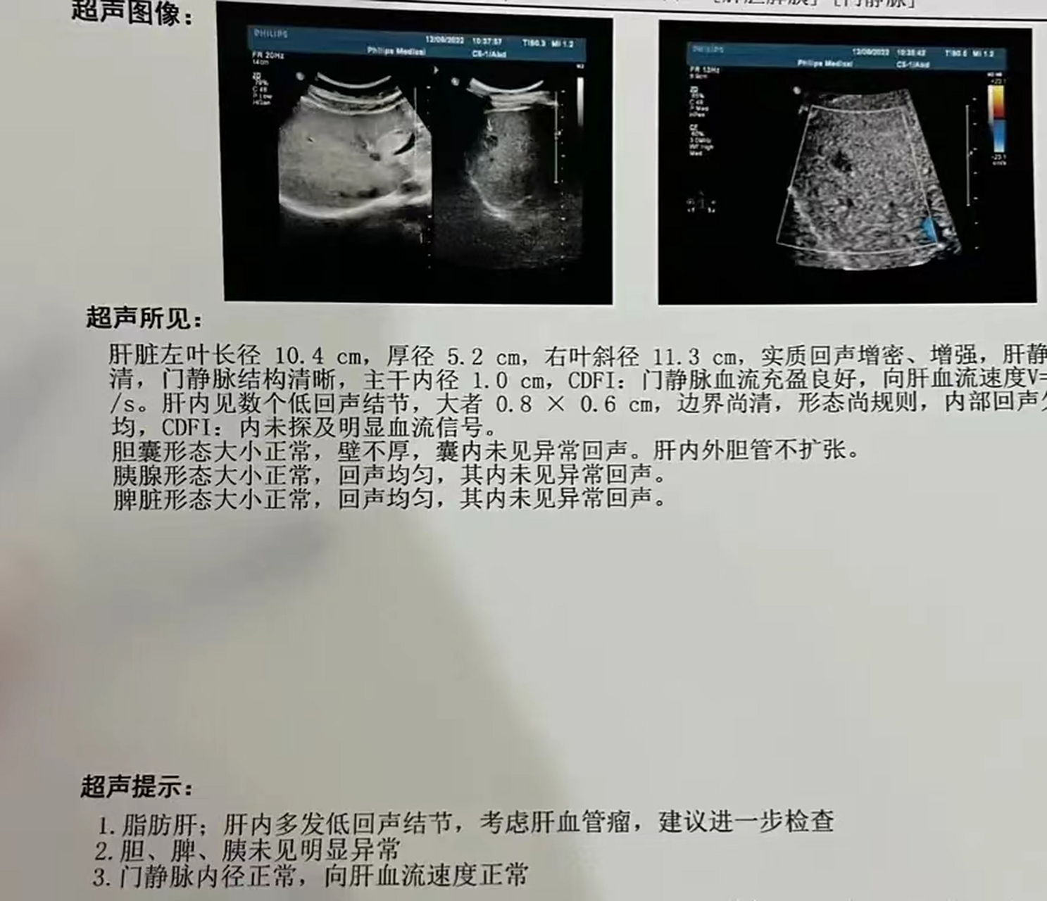 肝不好的人注意!肝血管瘤能发展肝癌?