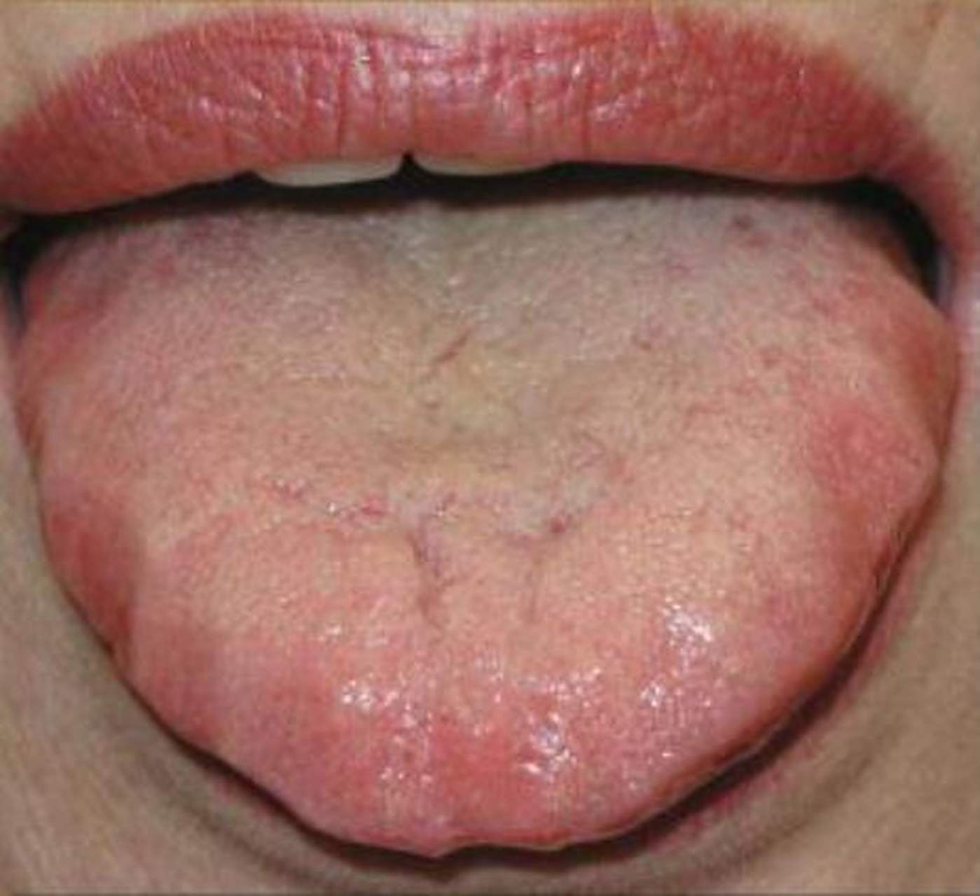 之一,是诊断心血管疾病血瘀证的重要依据,常见于冠心病,肺源性心脏病