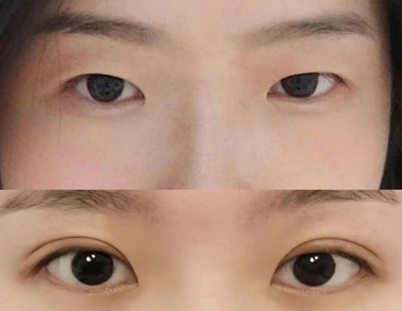 7mm的开扇双眼皮 没有很假吧 同事说一眼就能看出是割的,尴尬#全切双