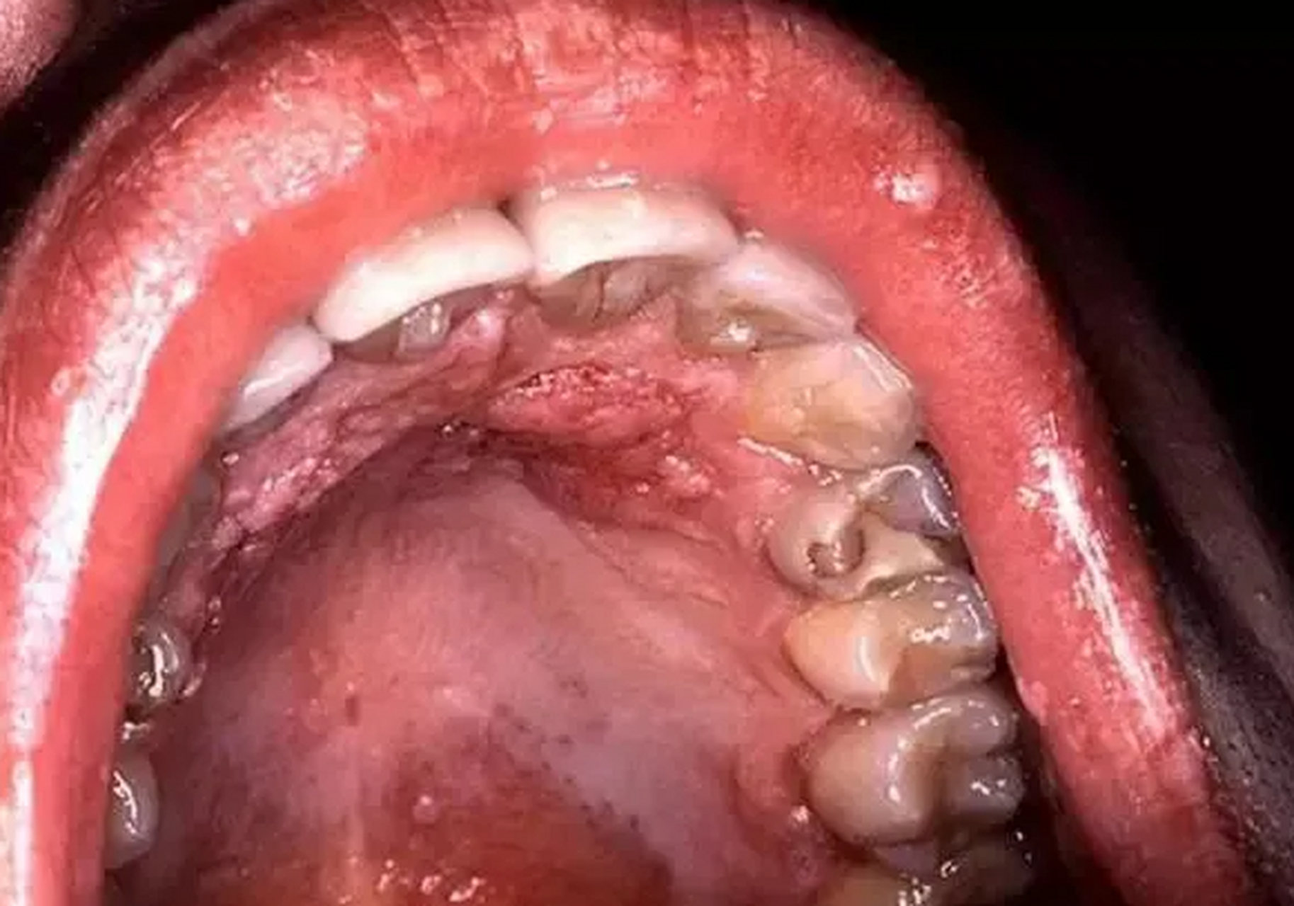 39岁的男子,最近1年,经常出现口腔溃疡的情况,牙齿也变黑了,刚开始他