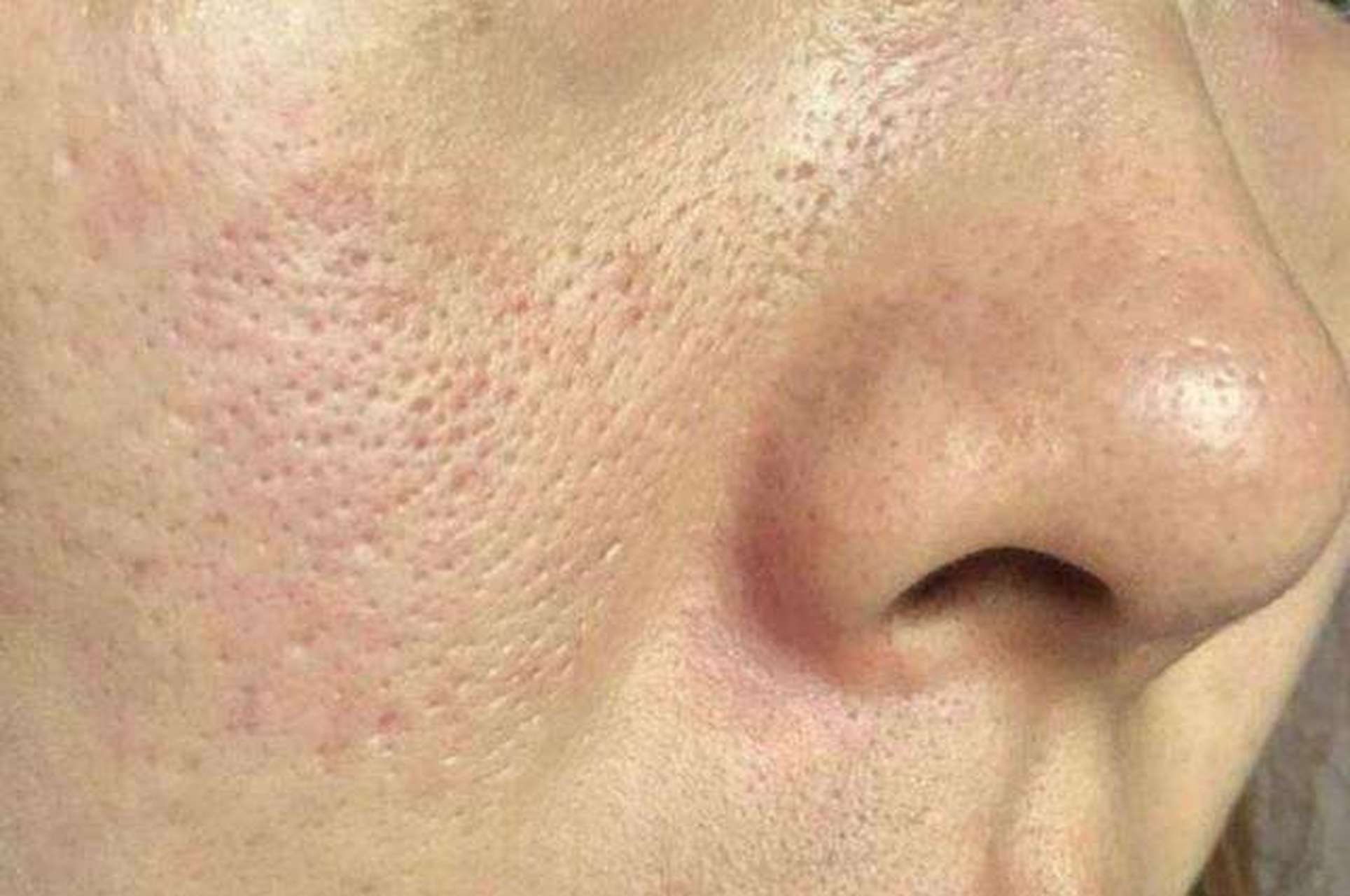 毛孔粗大,月球脸怎么办?试试光子嫩肤吧?