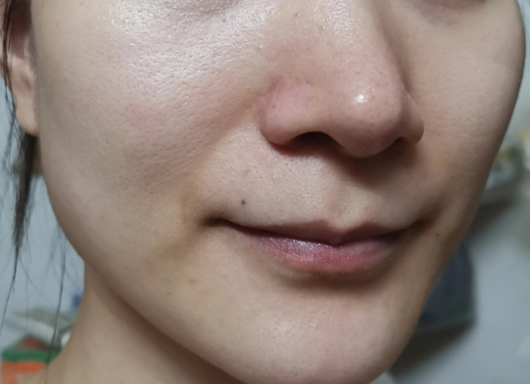 点阵激光剥脱效果图 #医美科普挑战赛#  点阵激光剥脱是一种常见的