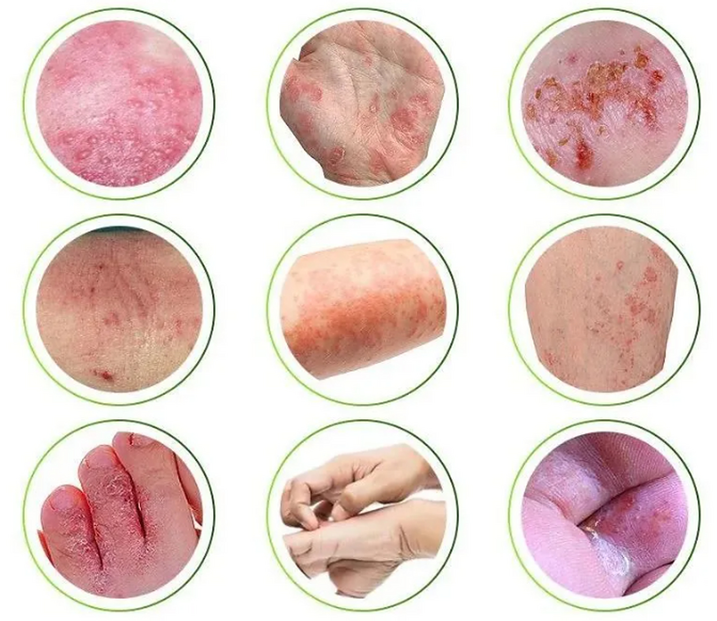 皮肤起红斑水泡非常痒,可能是急性湿疹  头上或者四肢,伴有瘙痒灼热感