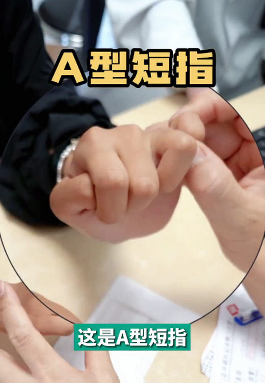 今天这个小朋友,双手集齐了3种短指症,a型,d型,e