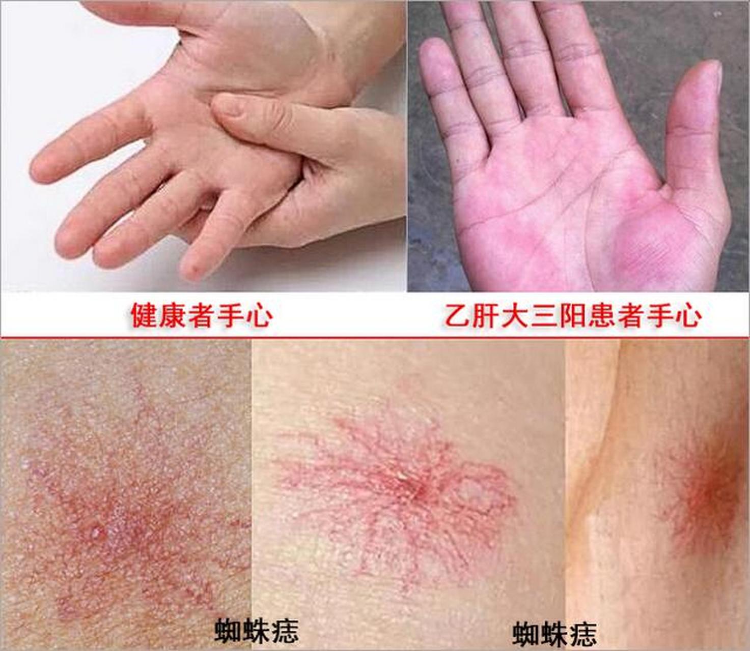 【肝掌,蜘蛛痣】  肝掌,蜘蛛痣是慢性肝病较常见,较典型的体征.