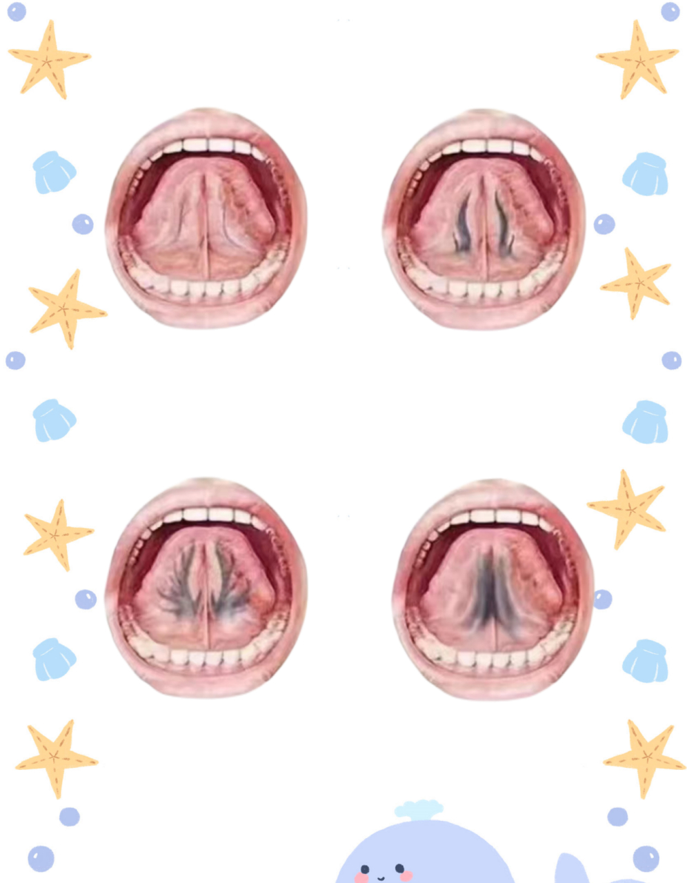 婴儿舌下有个缺口图片图片