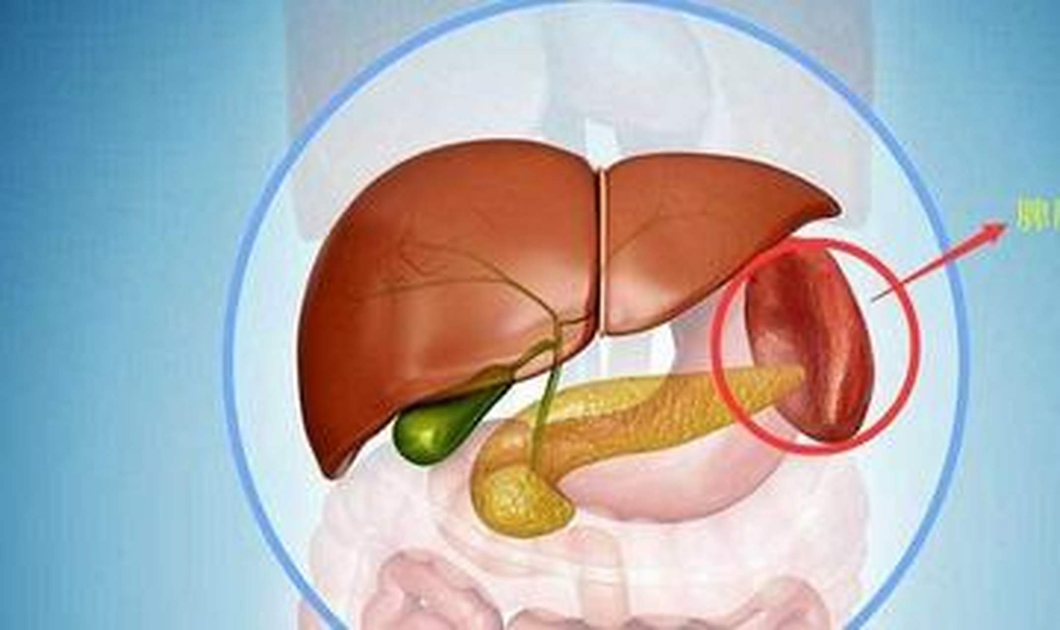 脾大是肝硬化哪个阶段 肝硬化根据临床表现可分为代偿期和失代偿期.