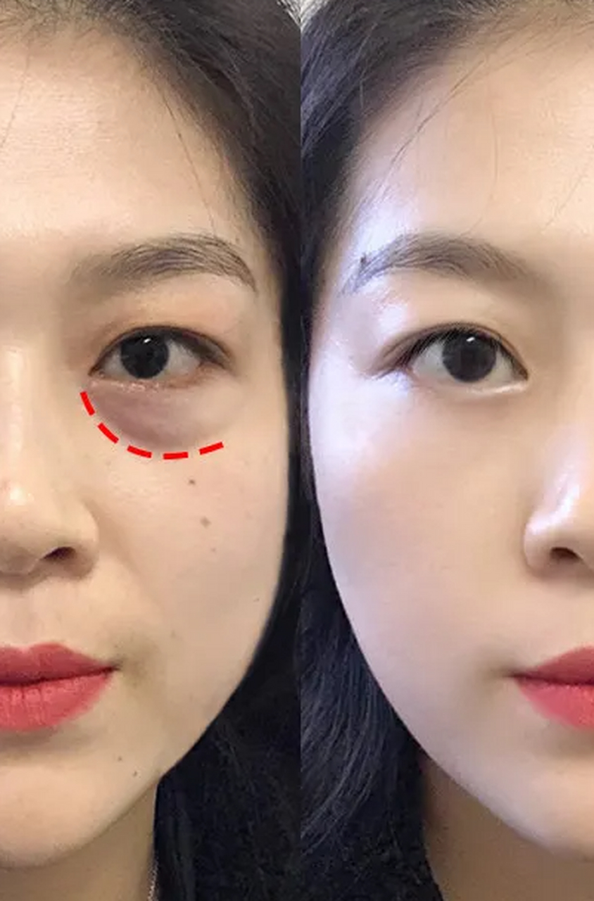 内切去眼袋# 内切眼袋多久恢复 内切眼袋是一种很常见的医美夏靠