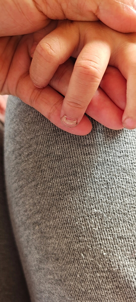 小儿手足口后指甲脱落正常吗