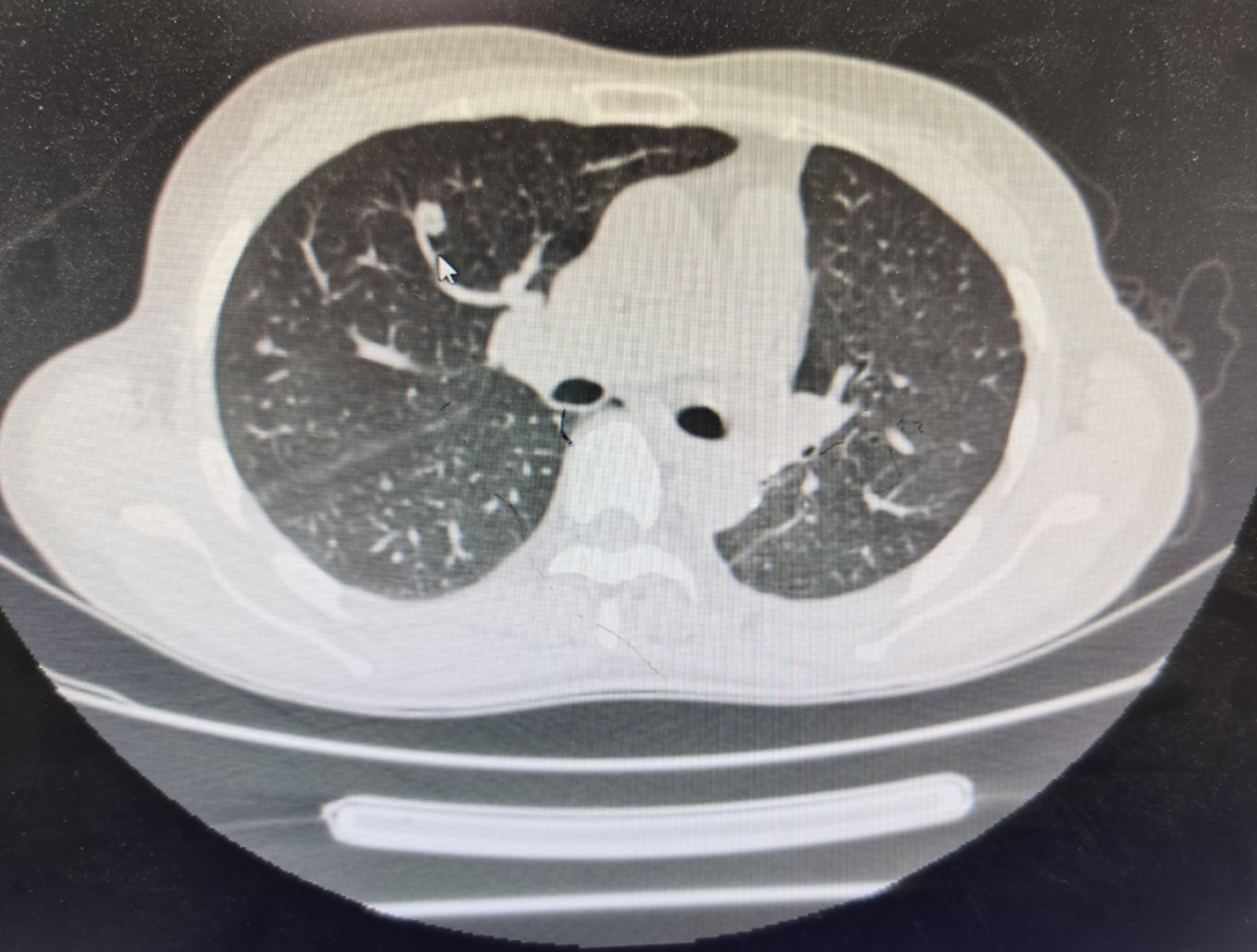 【纤维灶】一般就是结节.  【钙化灶】大多数是良性.