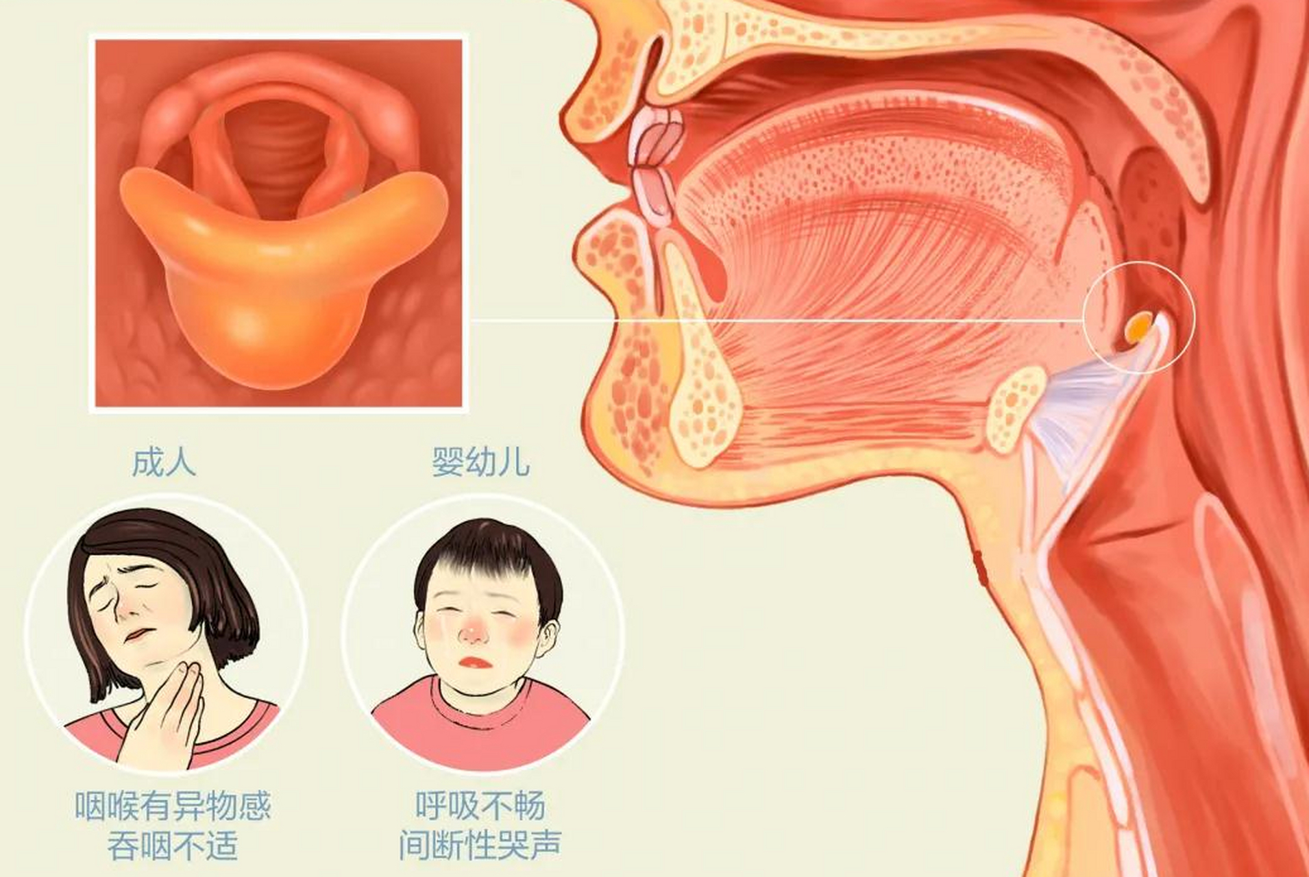 急性会厌炎的常见症状包括:   1喉部疼痛或灼热感; 2
