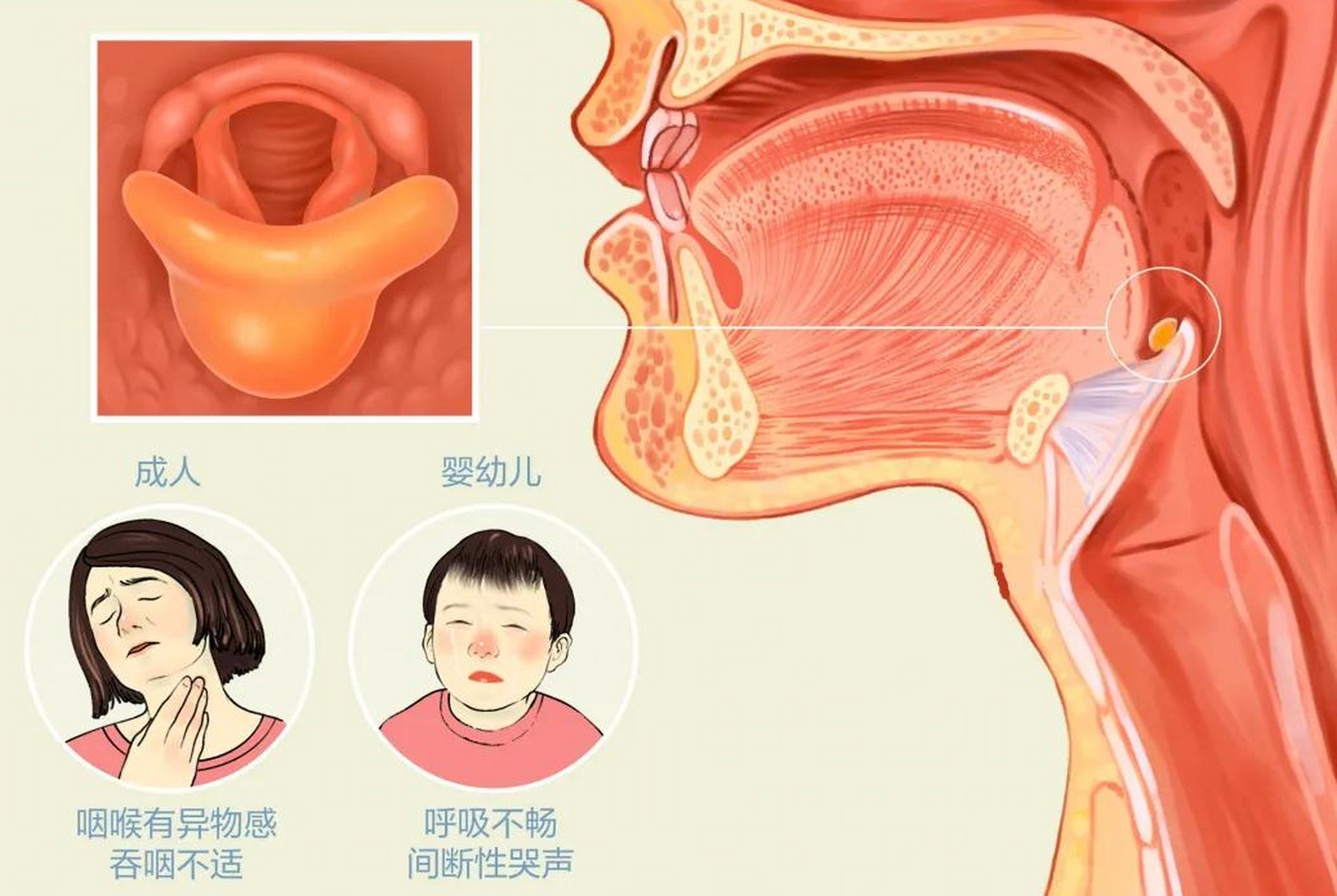 急性会厌炎的常见症状包括:   1.喉部疼痛或灼热感; 2.