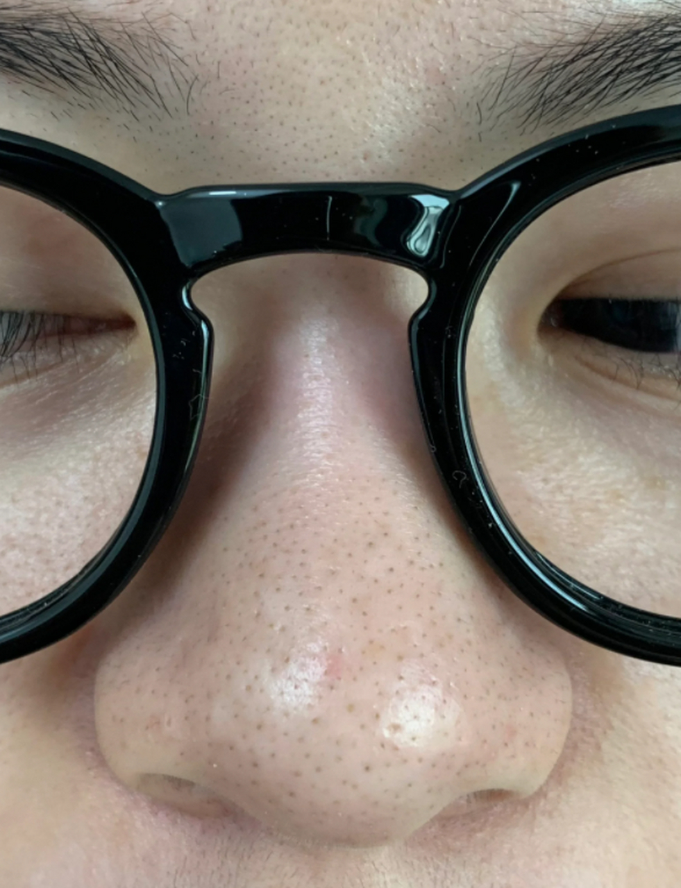 鼻子上的黑头怎么永久去掉?