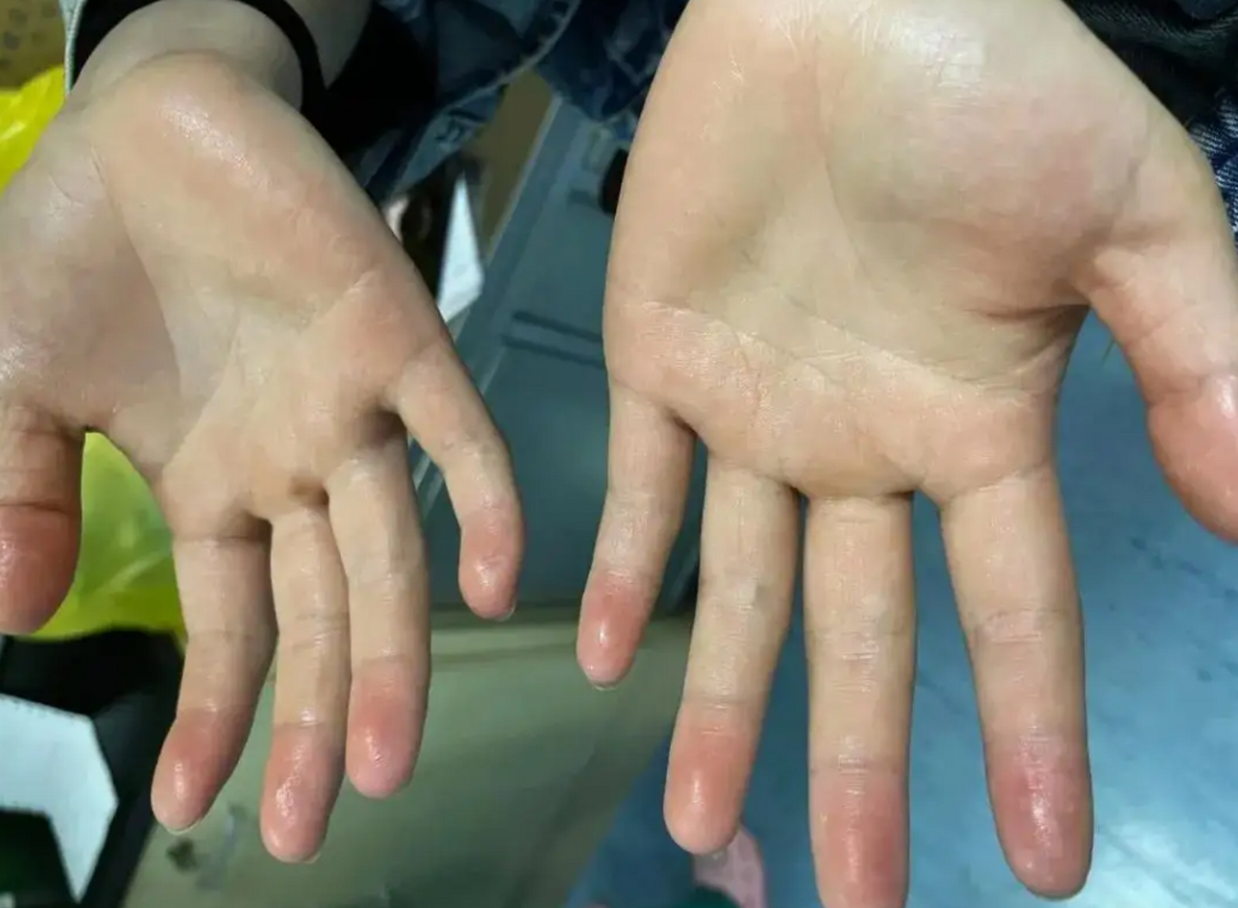 手很容易出汗怎么办# 原发性手汗症:胸交感神经长期处于亢奋状态