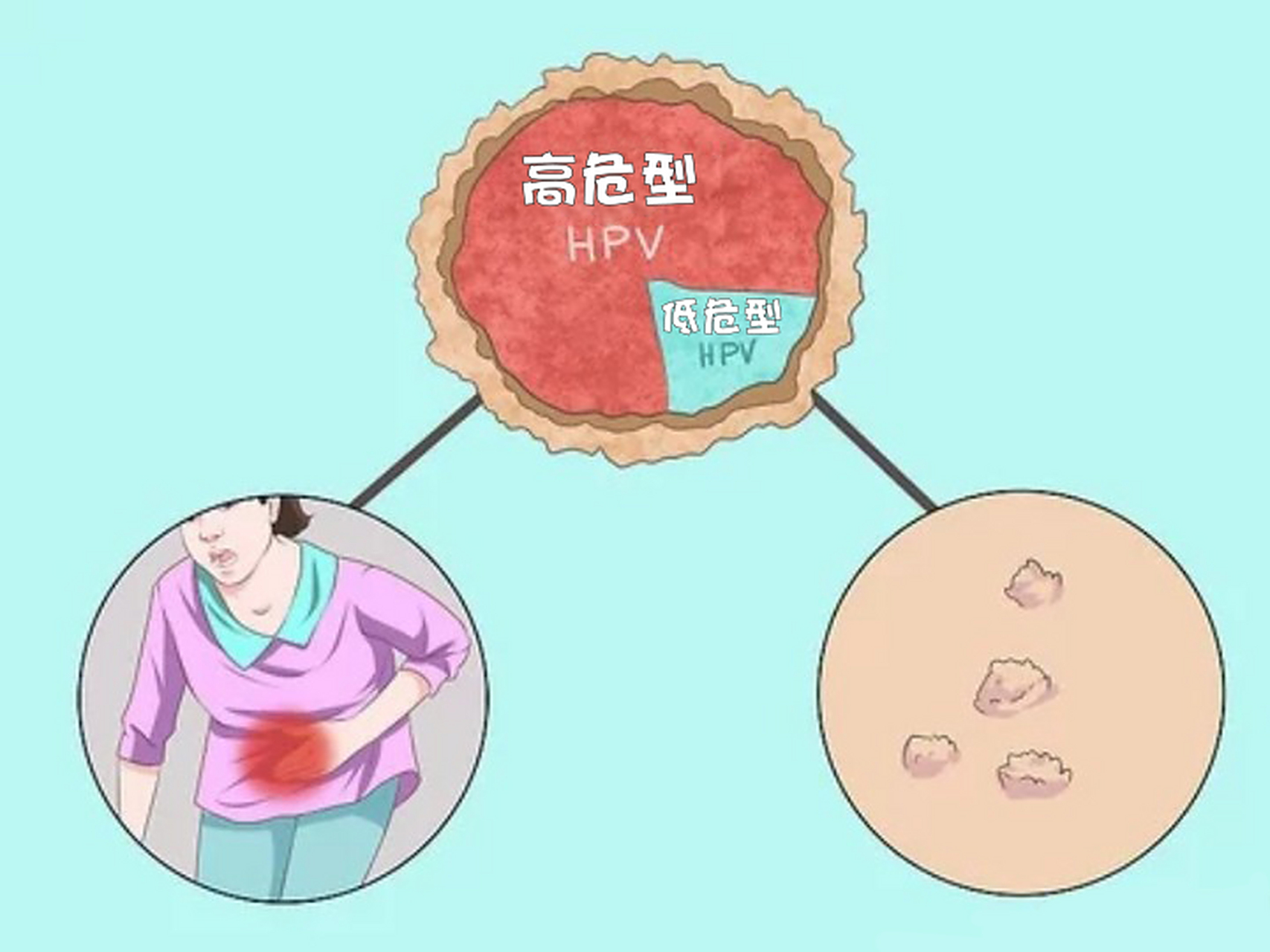 女性的尖锐湿疣主要会出现在以下部位:大小阴唇,肛周,宫颈,阴道口