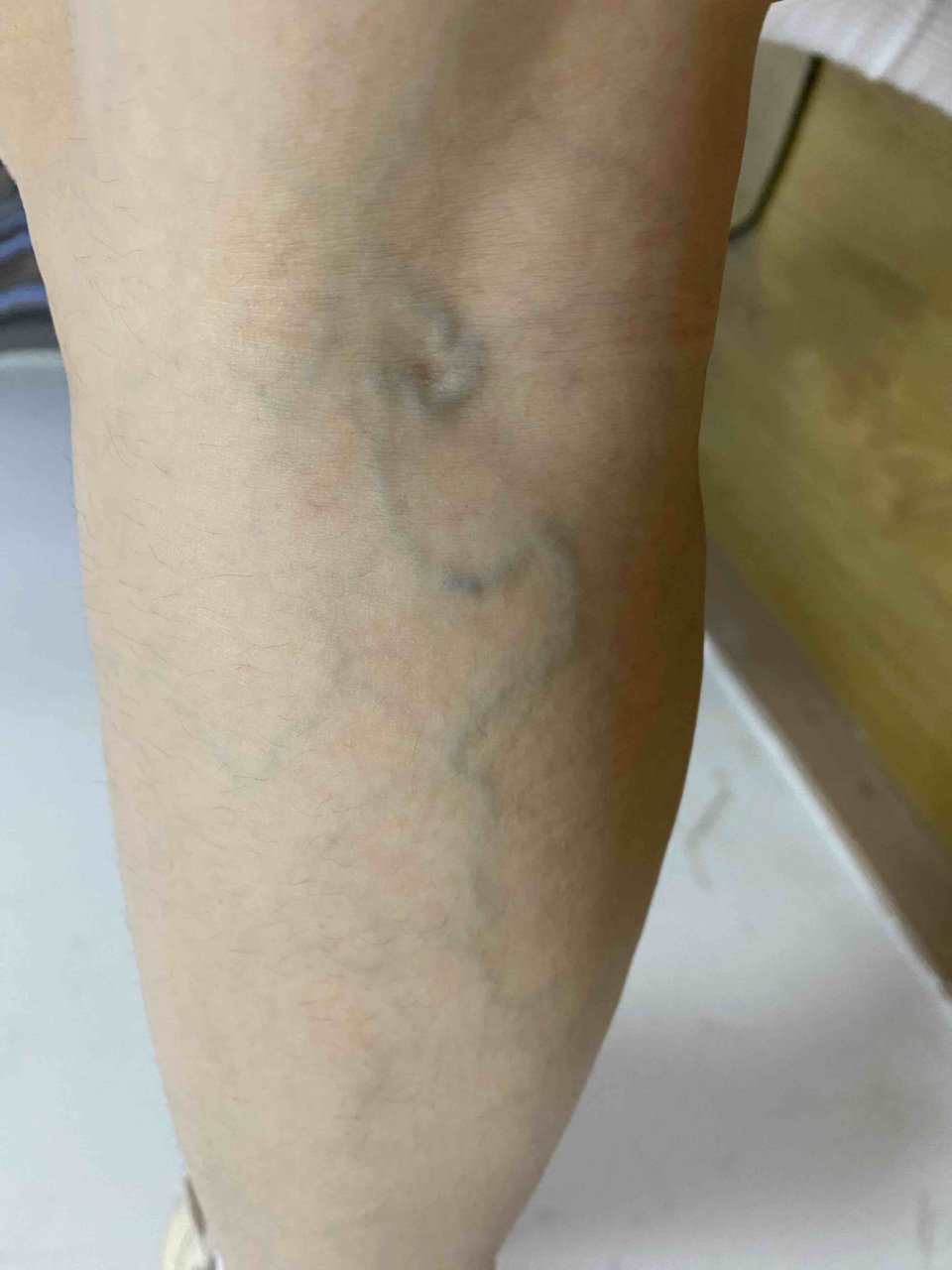 真的!腿部红血丝不要再担心了.