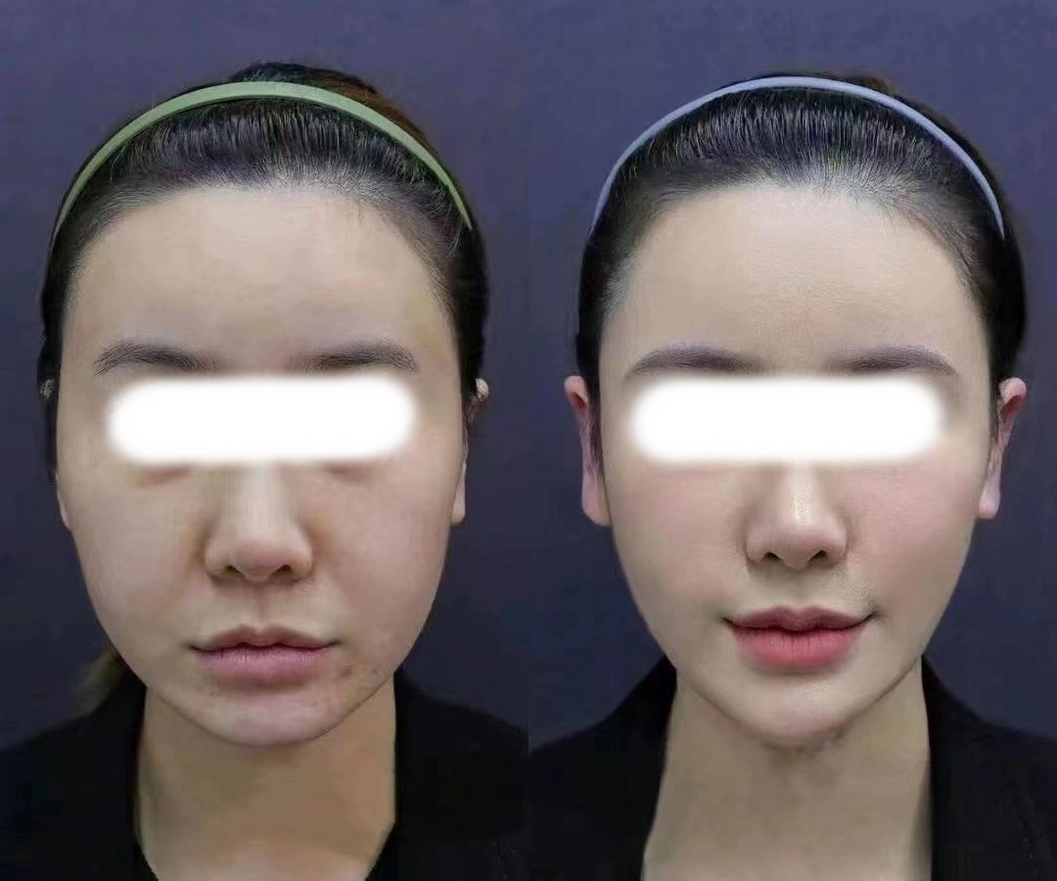 无痕筋膜提升效果对比 30分钟就能够让你维持三年 彻底解决中下面部